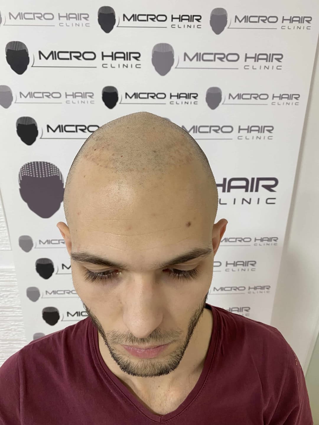 micro-hair-clinic