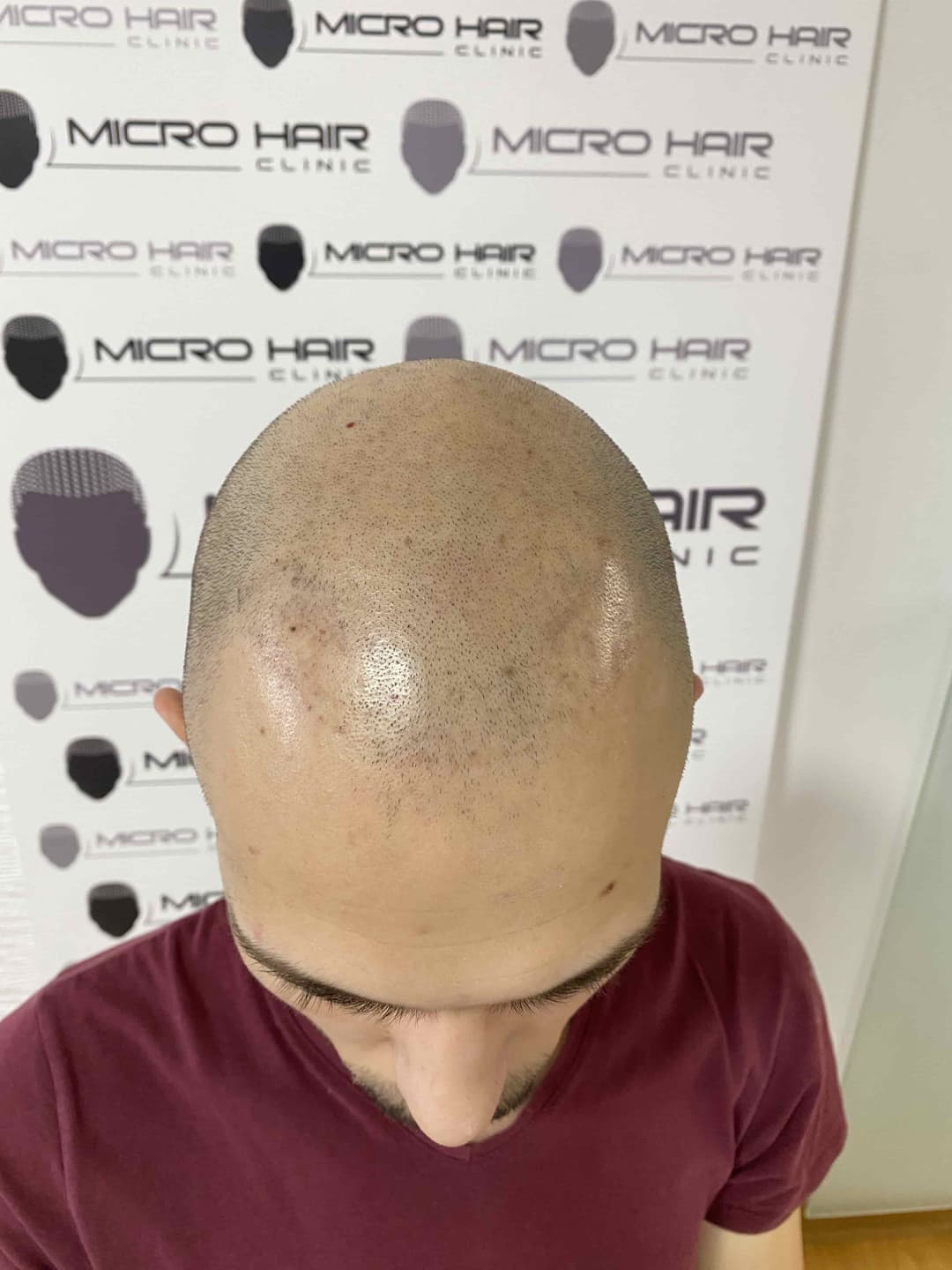 micro-hair-clinic