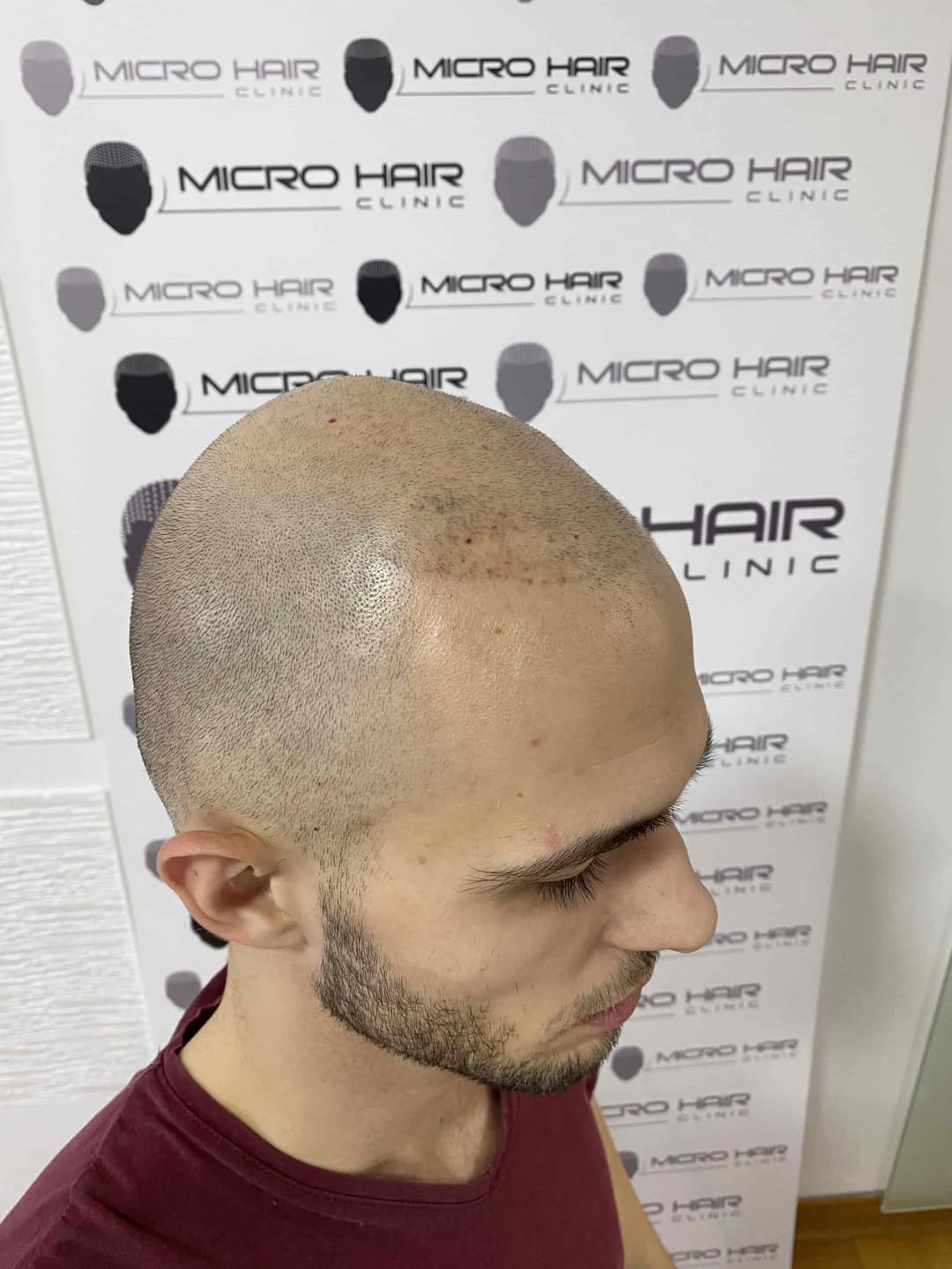 micro-hair-clinic