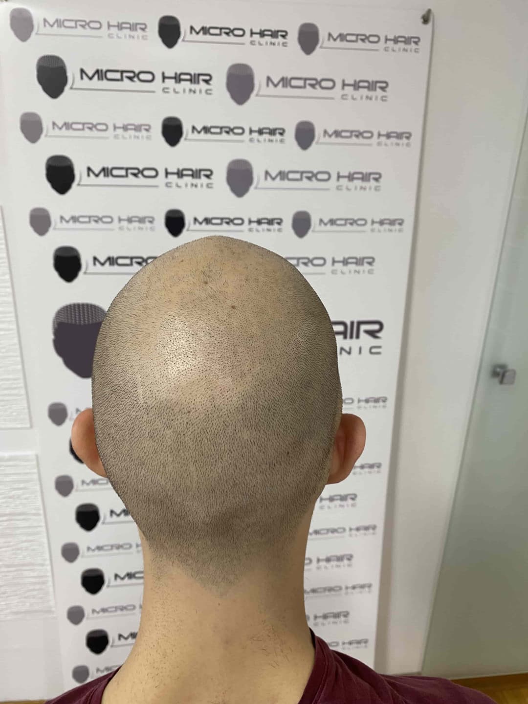 micro-hair-clinic