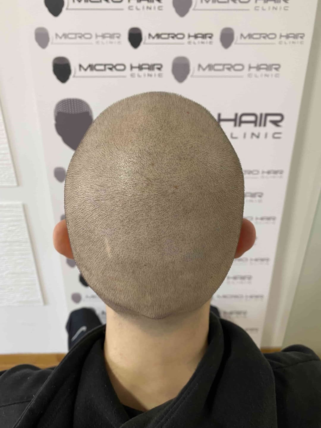 micro-hair-clinic