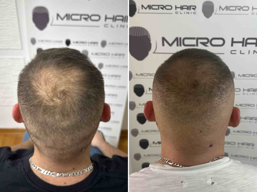 Scalp micropigmentation process