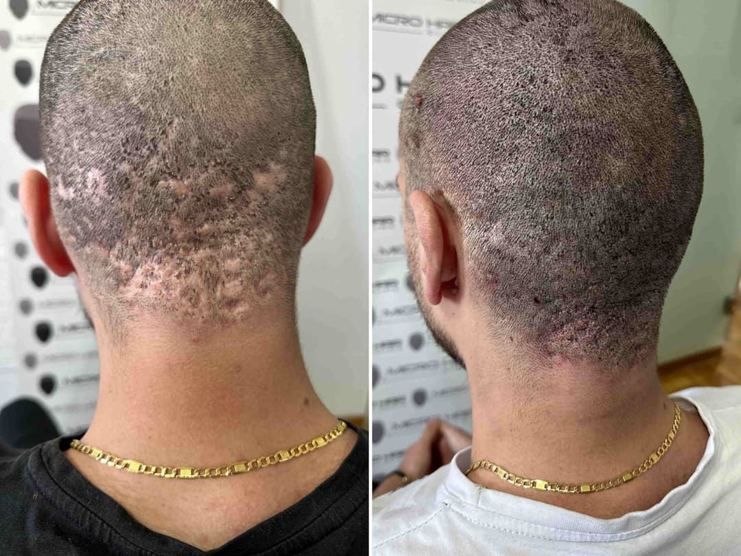 Before and after SMP treatment for transplant scar
