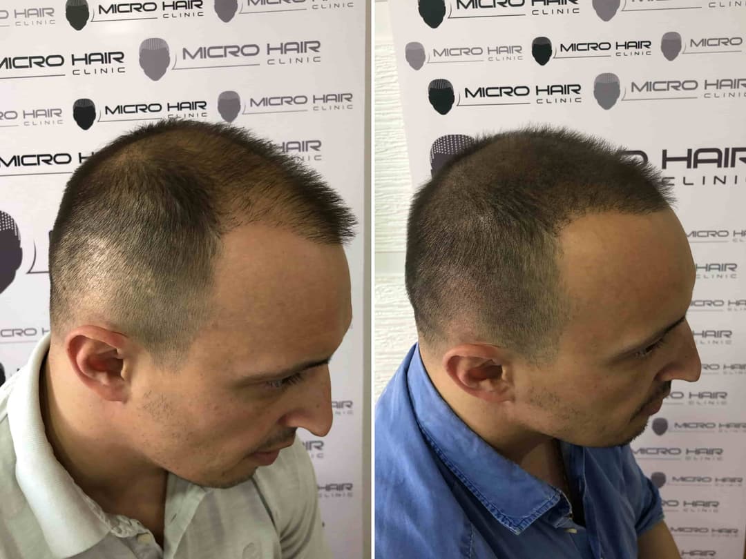 How pigment covers the scar on the scalp