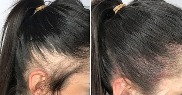 Areas most affected by female hair thinning
