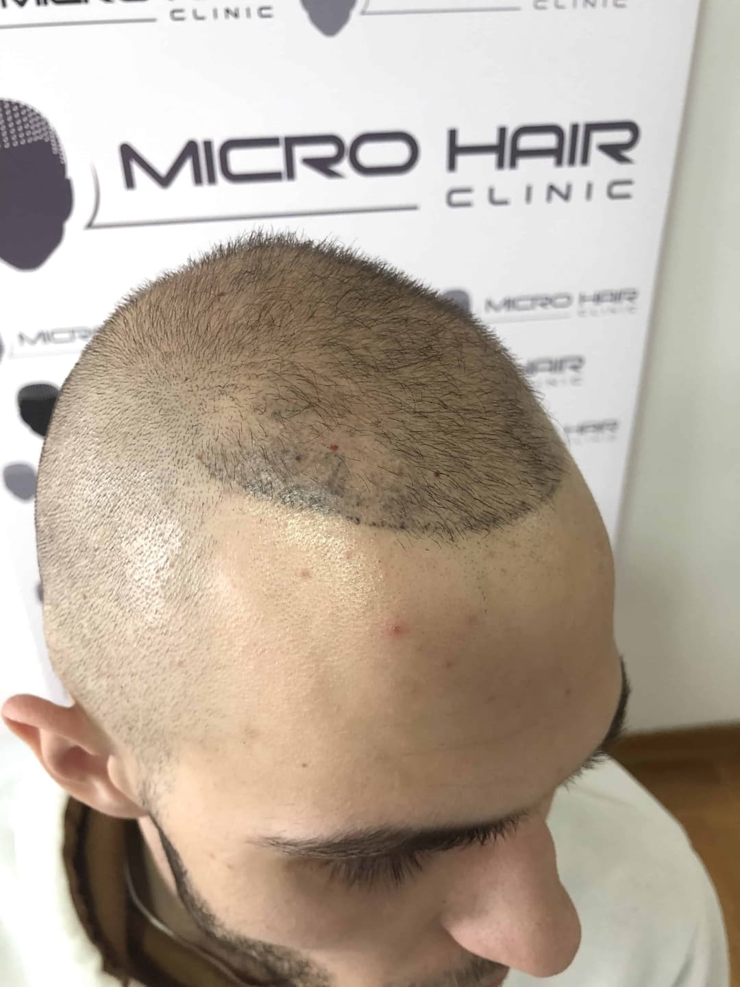 micro-hair-clinic