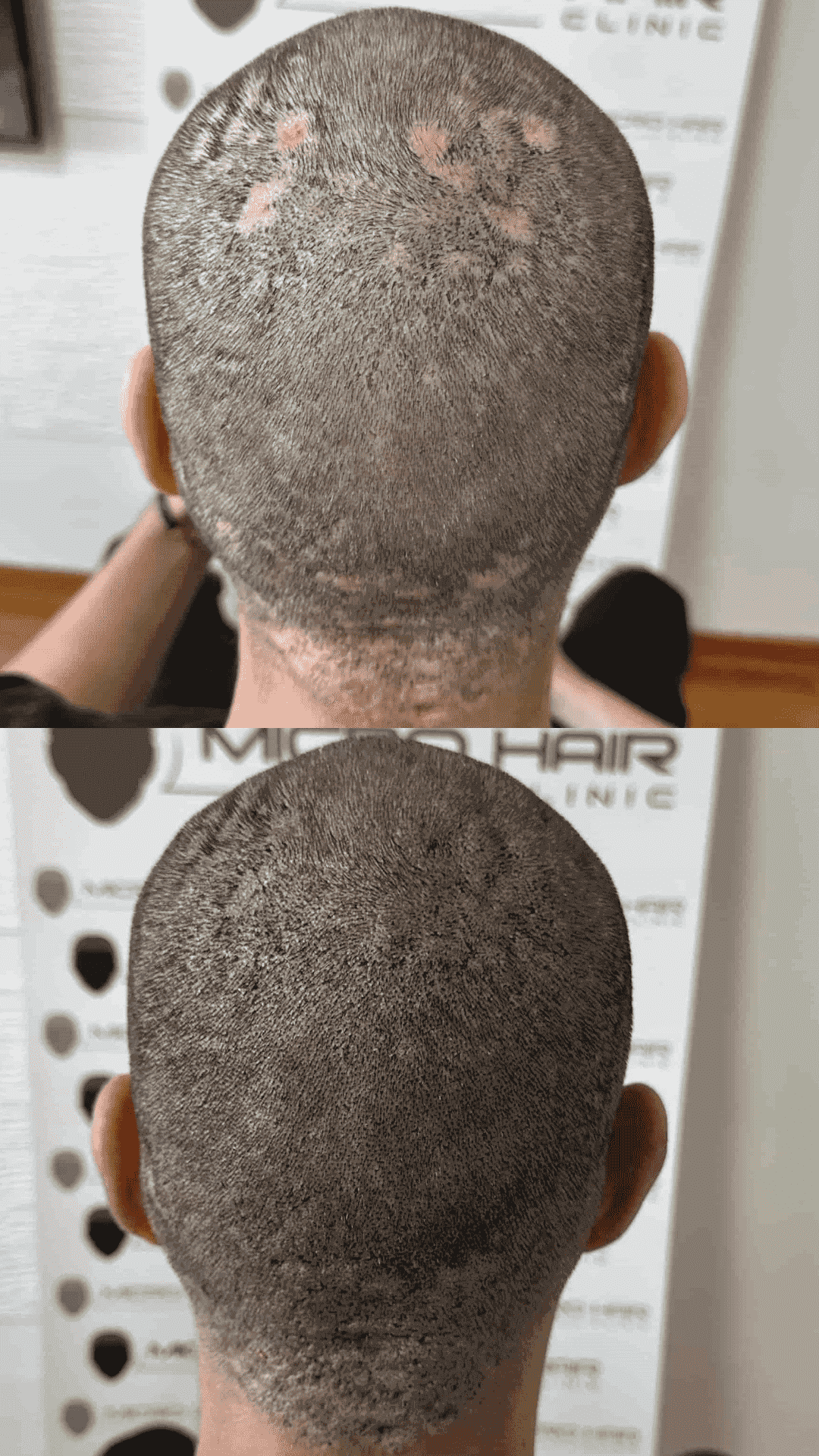 SMP result on a client with alopecia areata