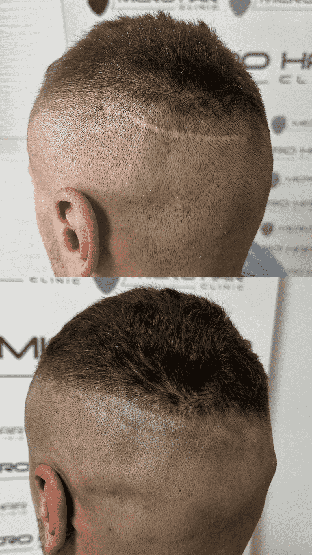SMP result – scar coverage on the scalp