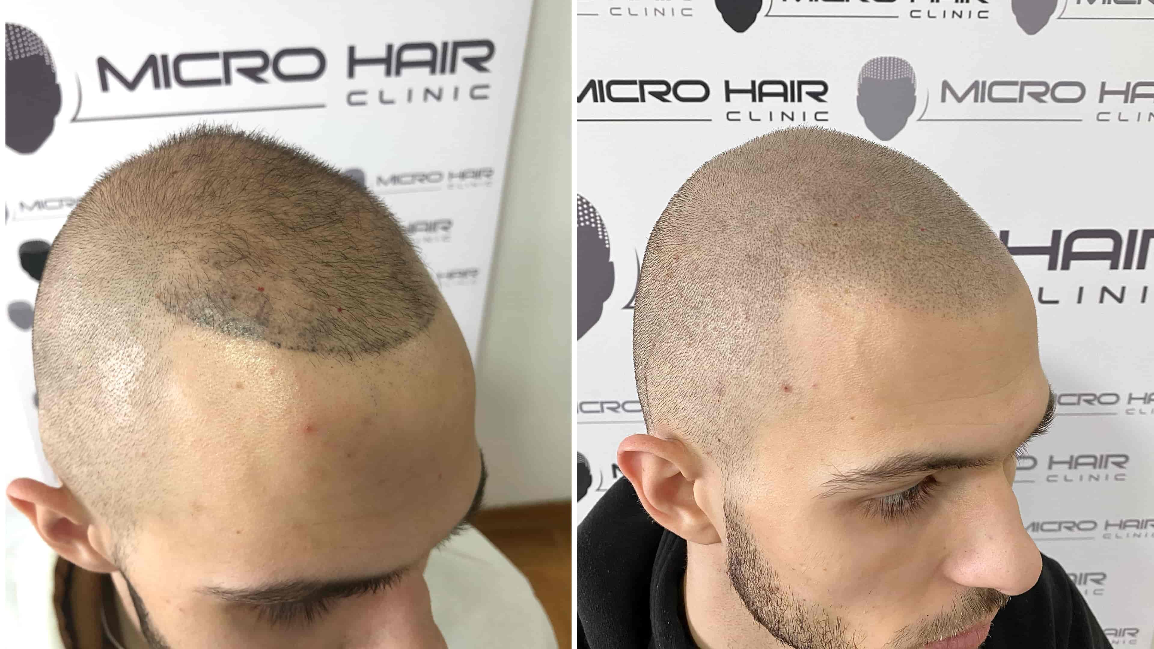 Correction of a poorly done scalp micropigmentation – before and after