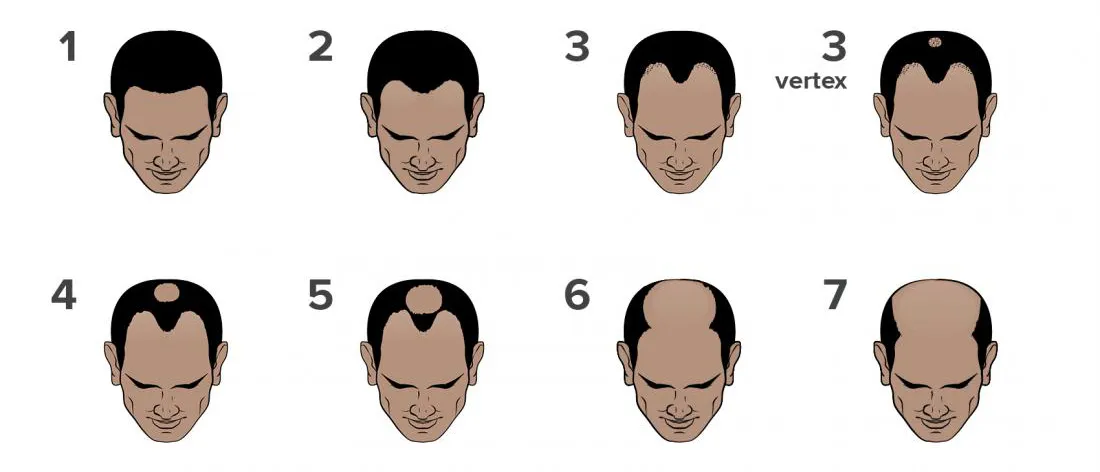 Stages of hair loss in men – Norwood scale