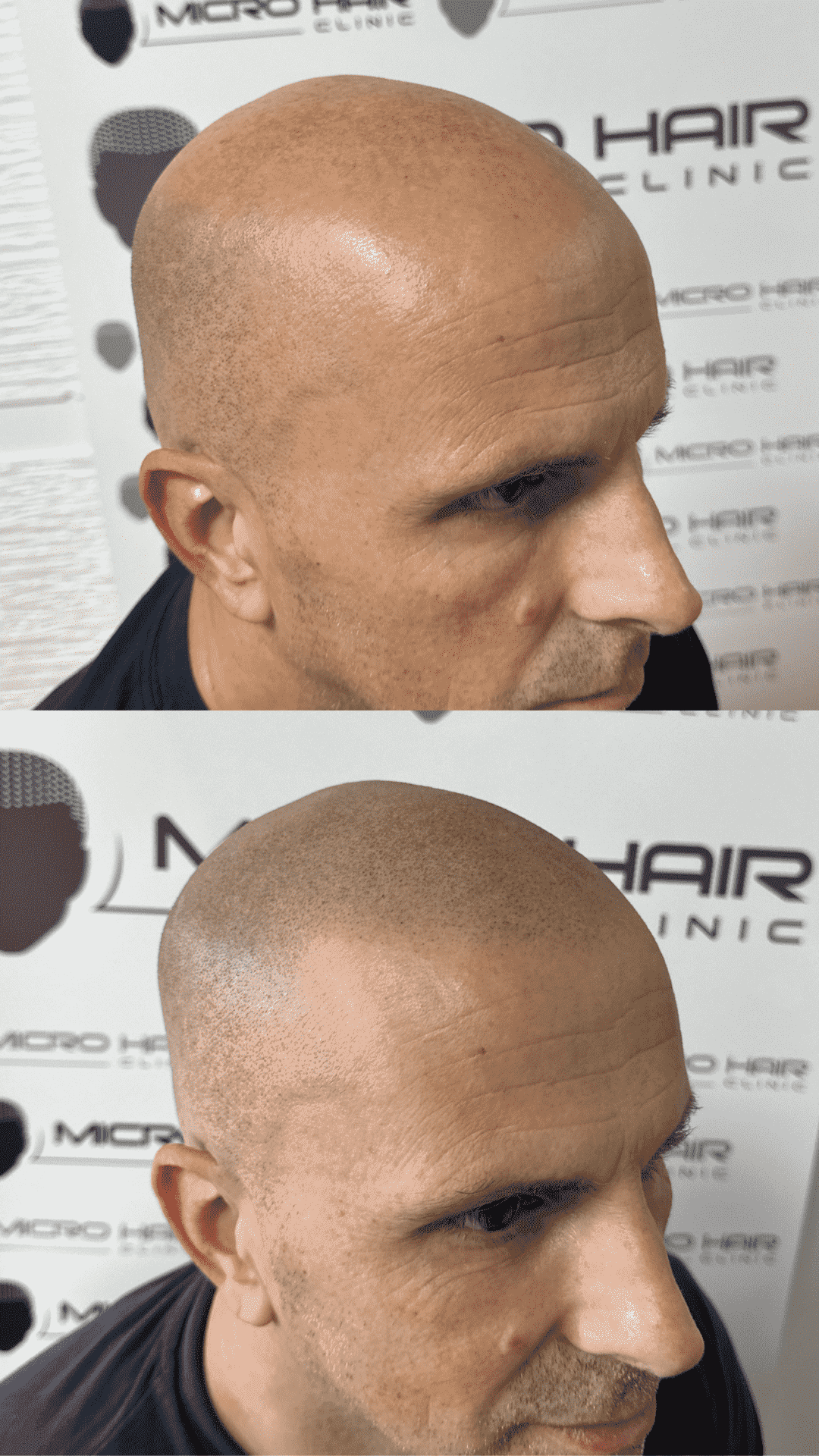 SMP result on a man with baldness (Norwood 6)