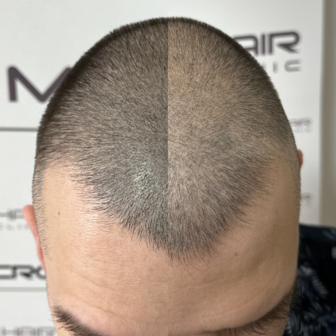 micro-hair-clinic