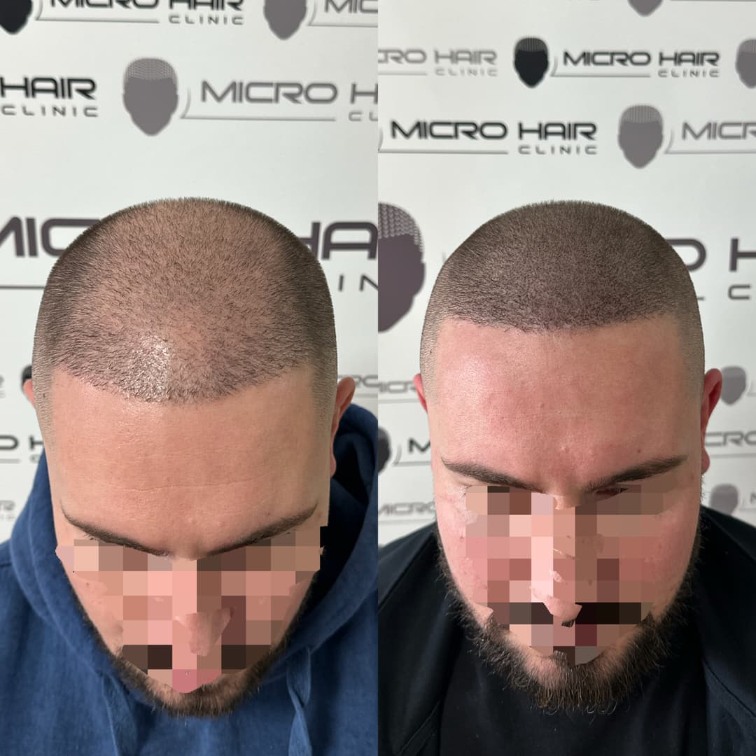 micro-hair-clinic
