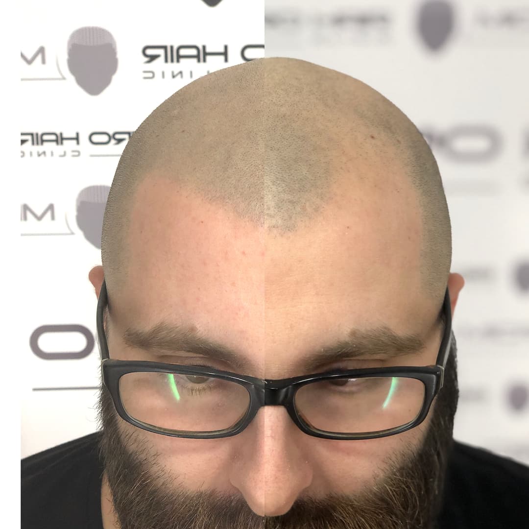 micro-hair-clinic