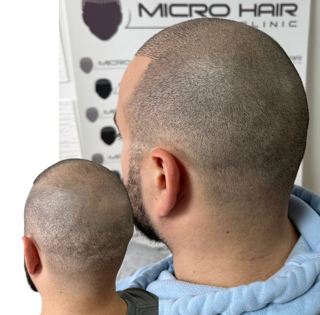 micro-hair-clinic