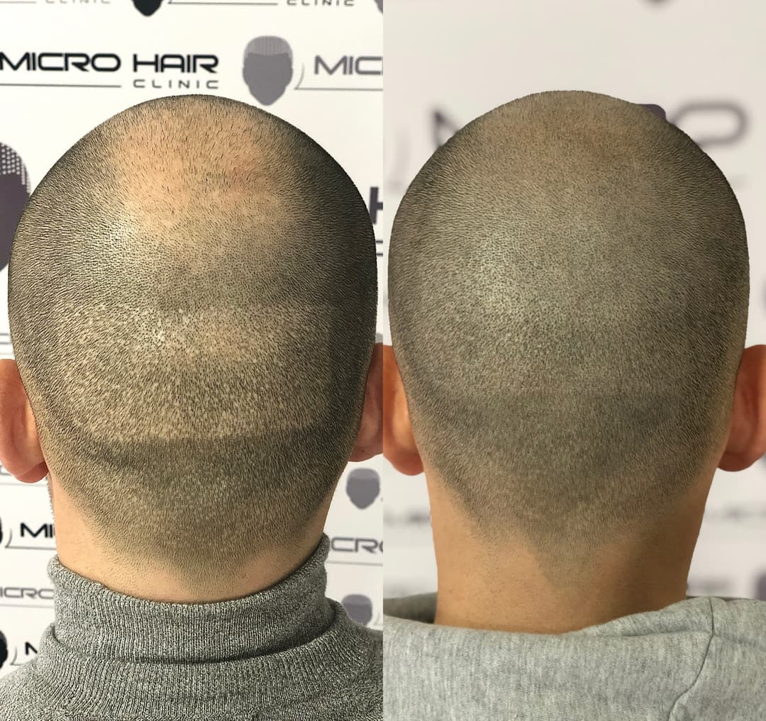 micro-hair-clinic