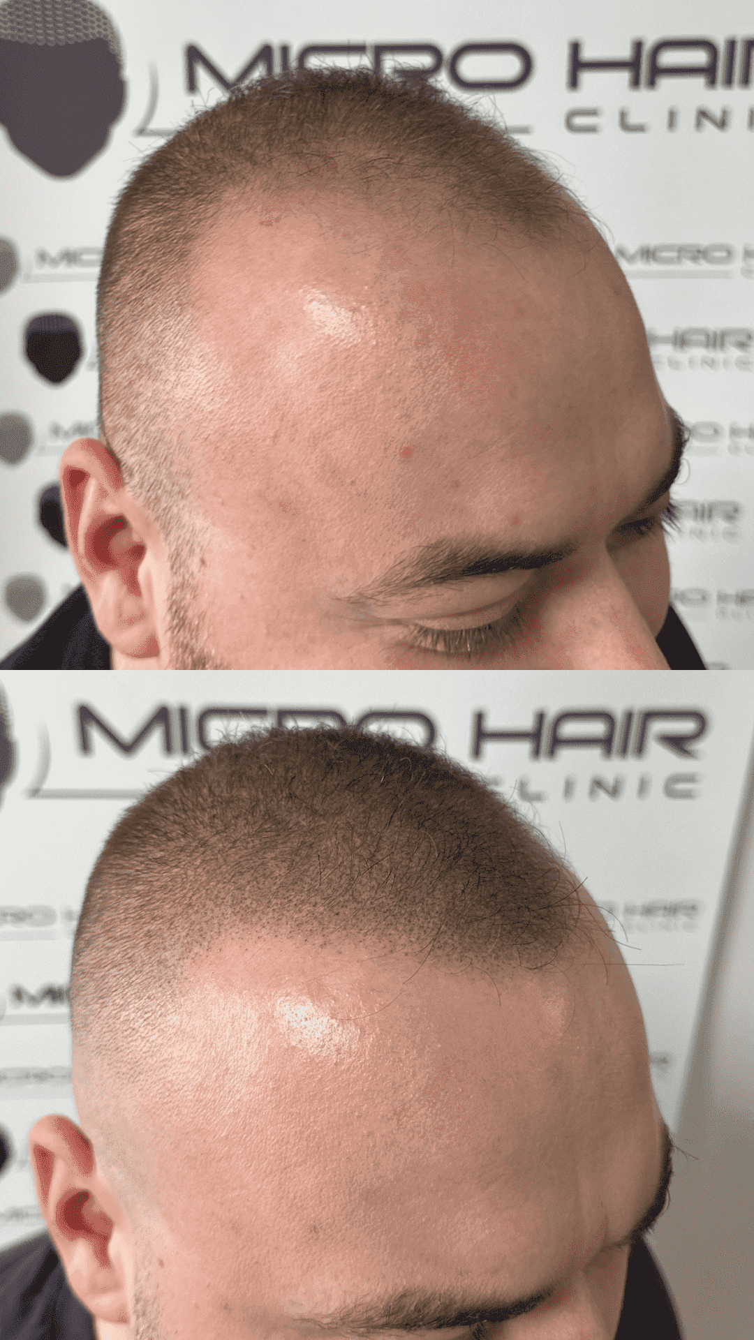 smp-density-increase-thinning-hair