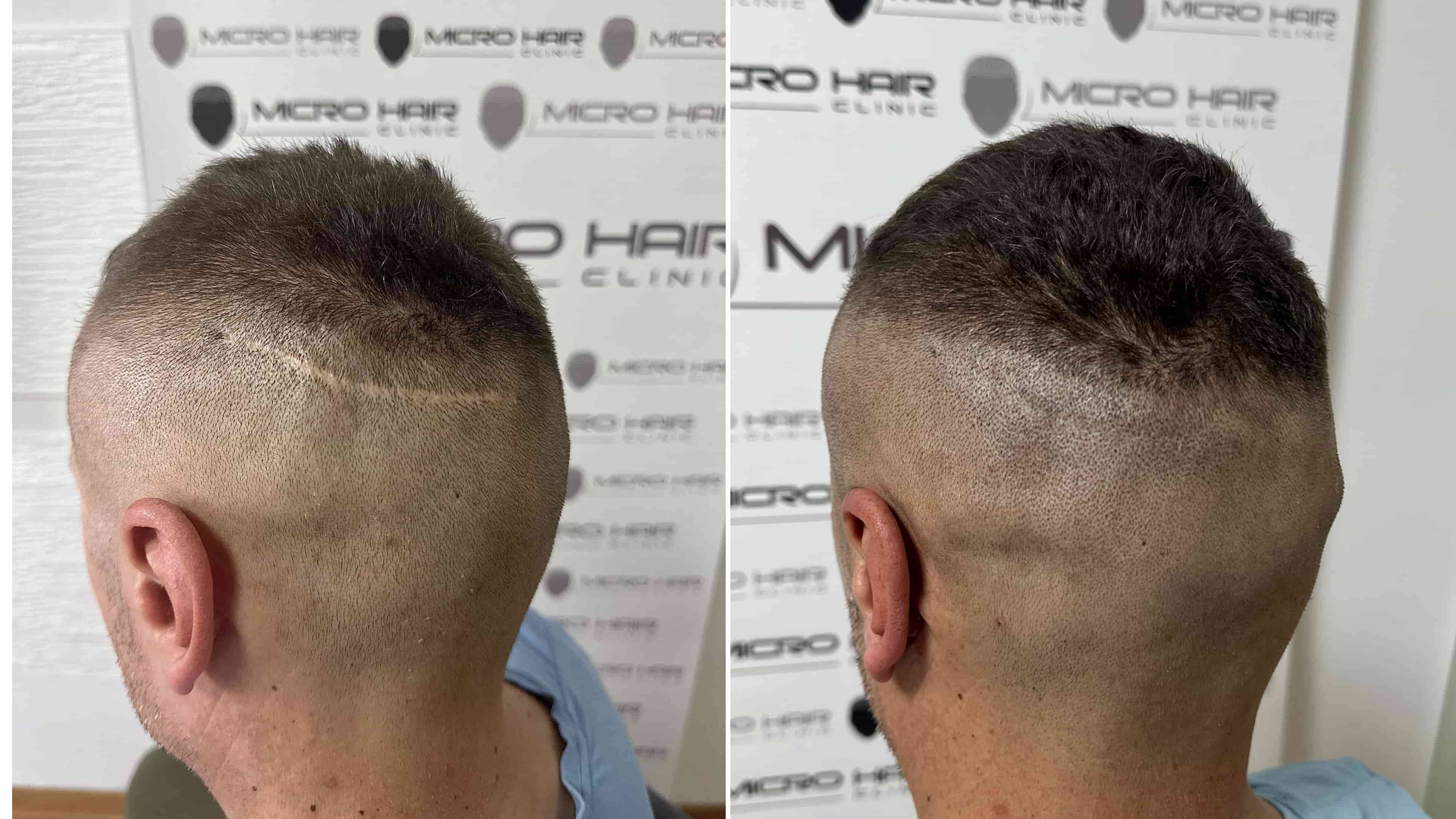 SMP result – scar coverage on the scalp