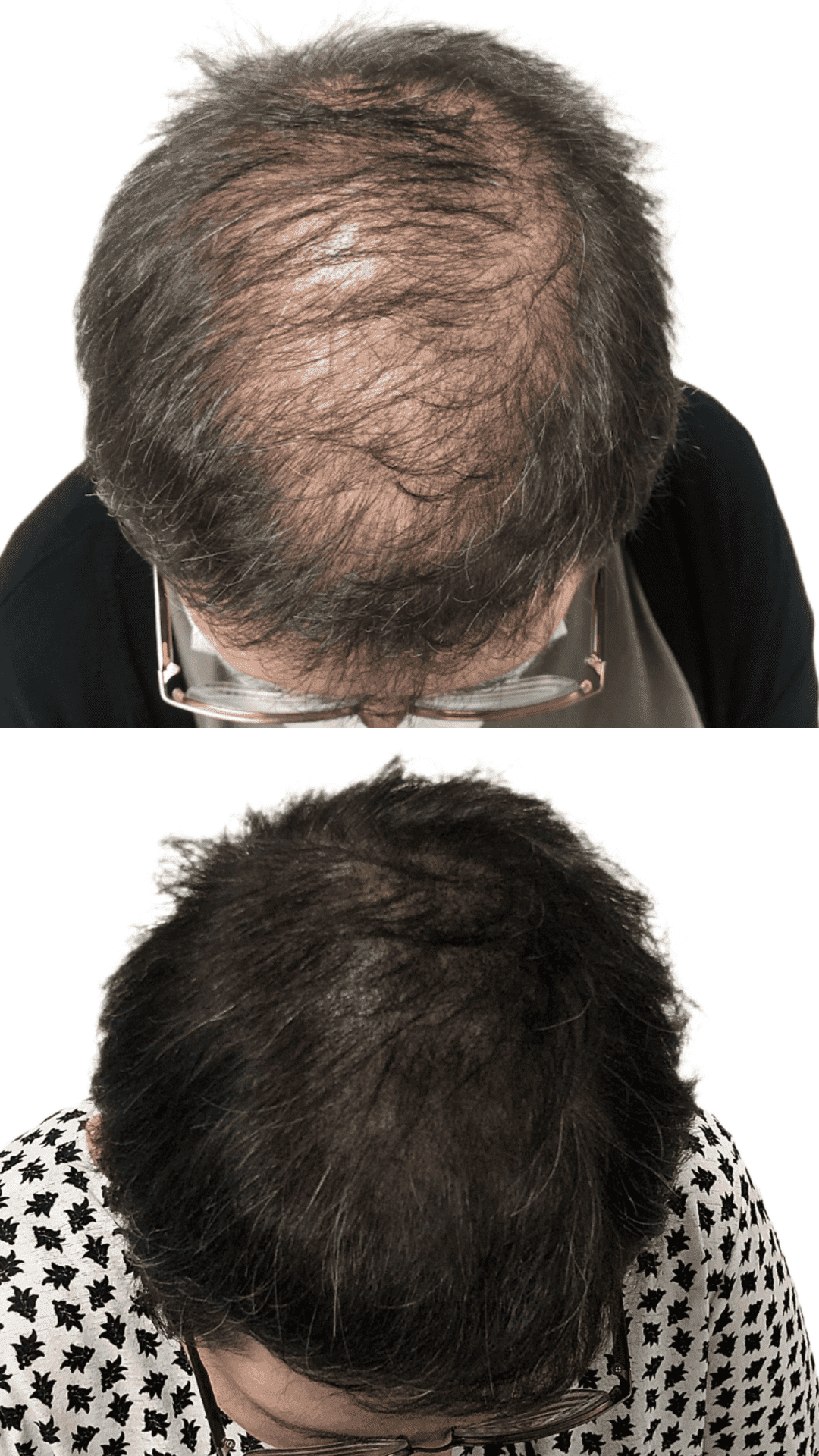SMP result on a woman with thinning hair at the crown