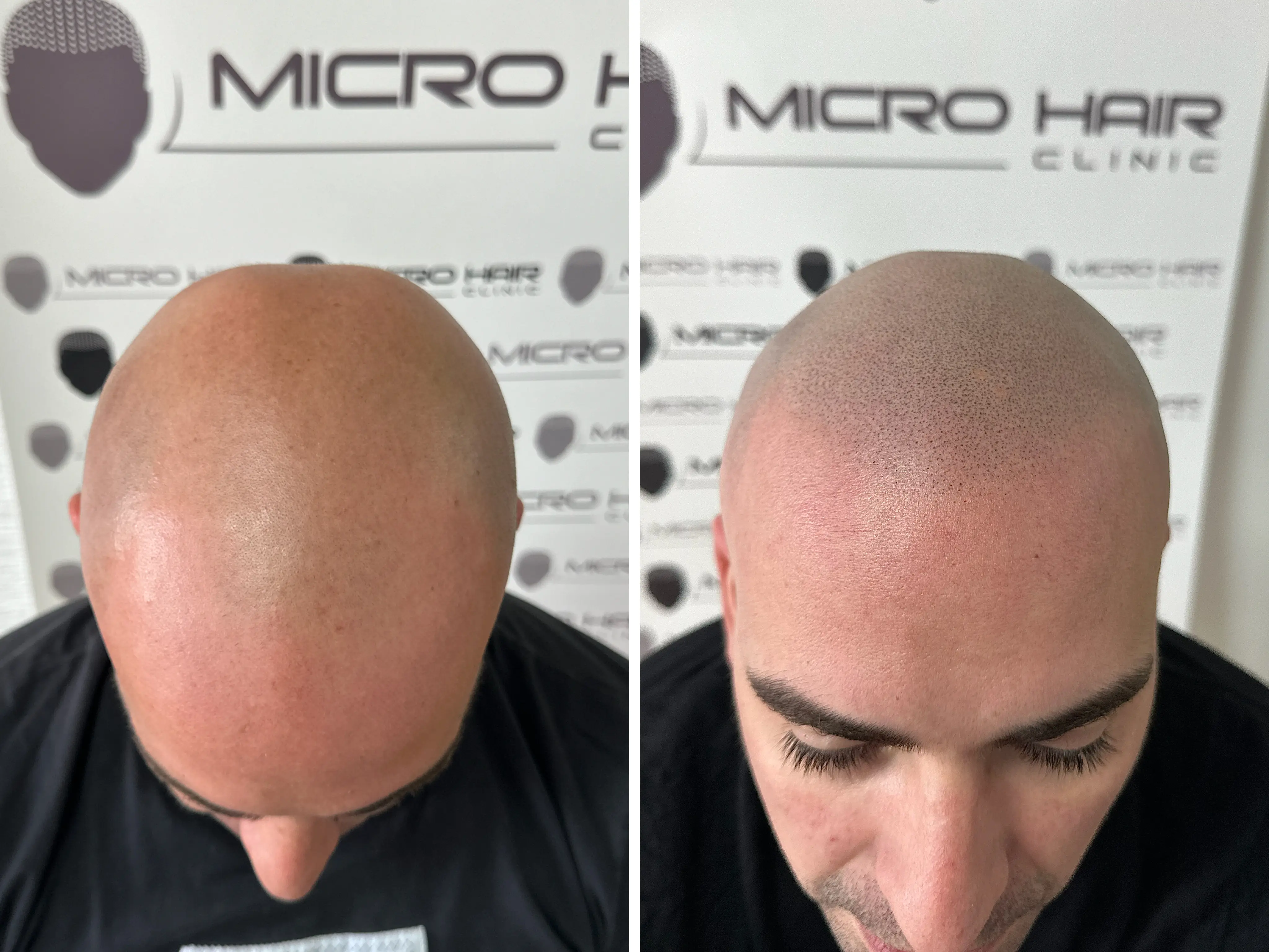 SMP rezultat pred in po - tretman mikropigmentacije 11