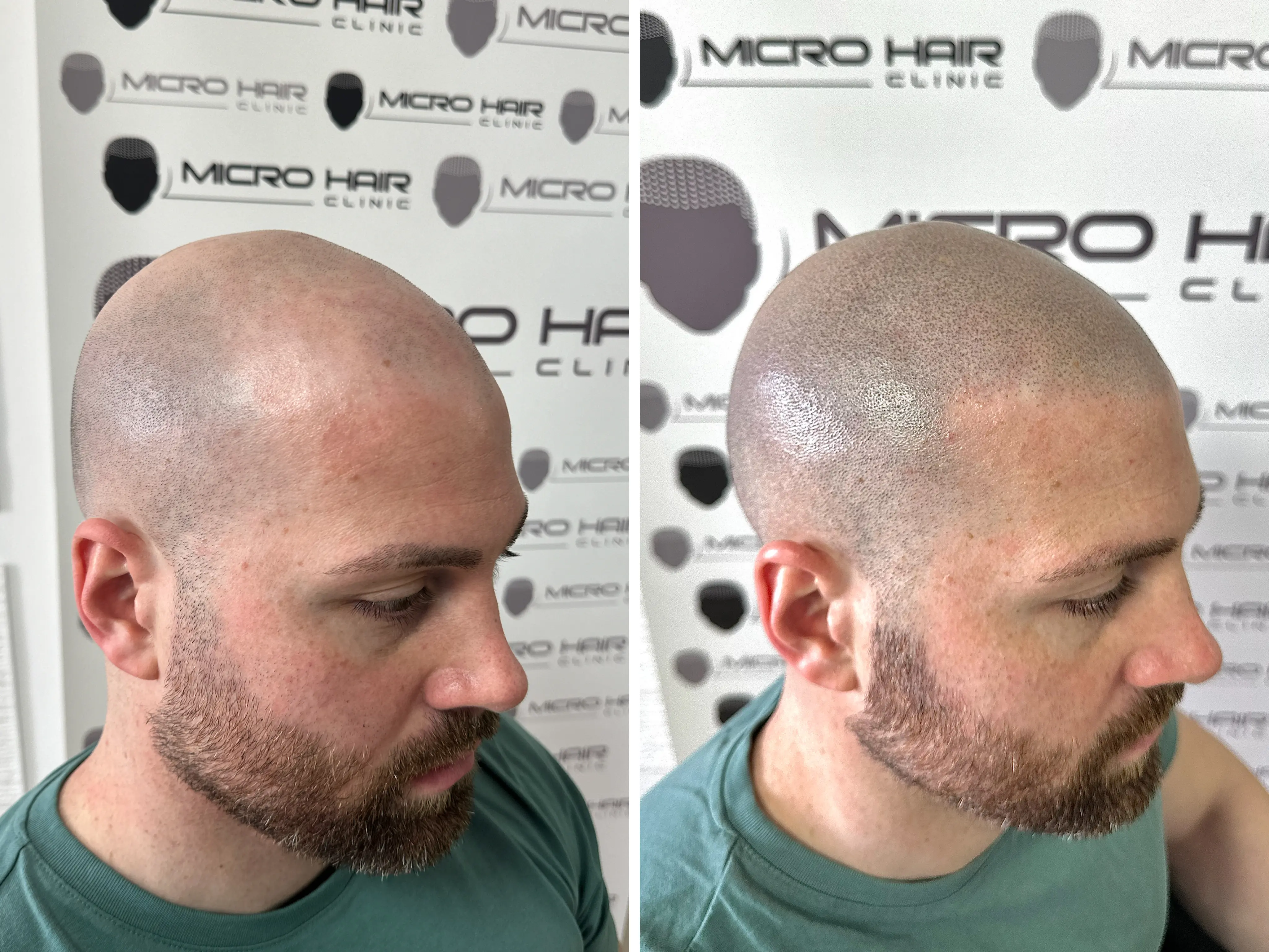 SMP rezultat pred in po - tretman mikropigmentacije 12