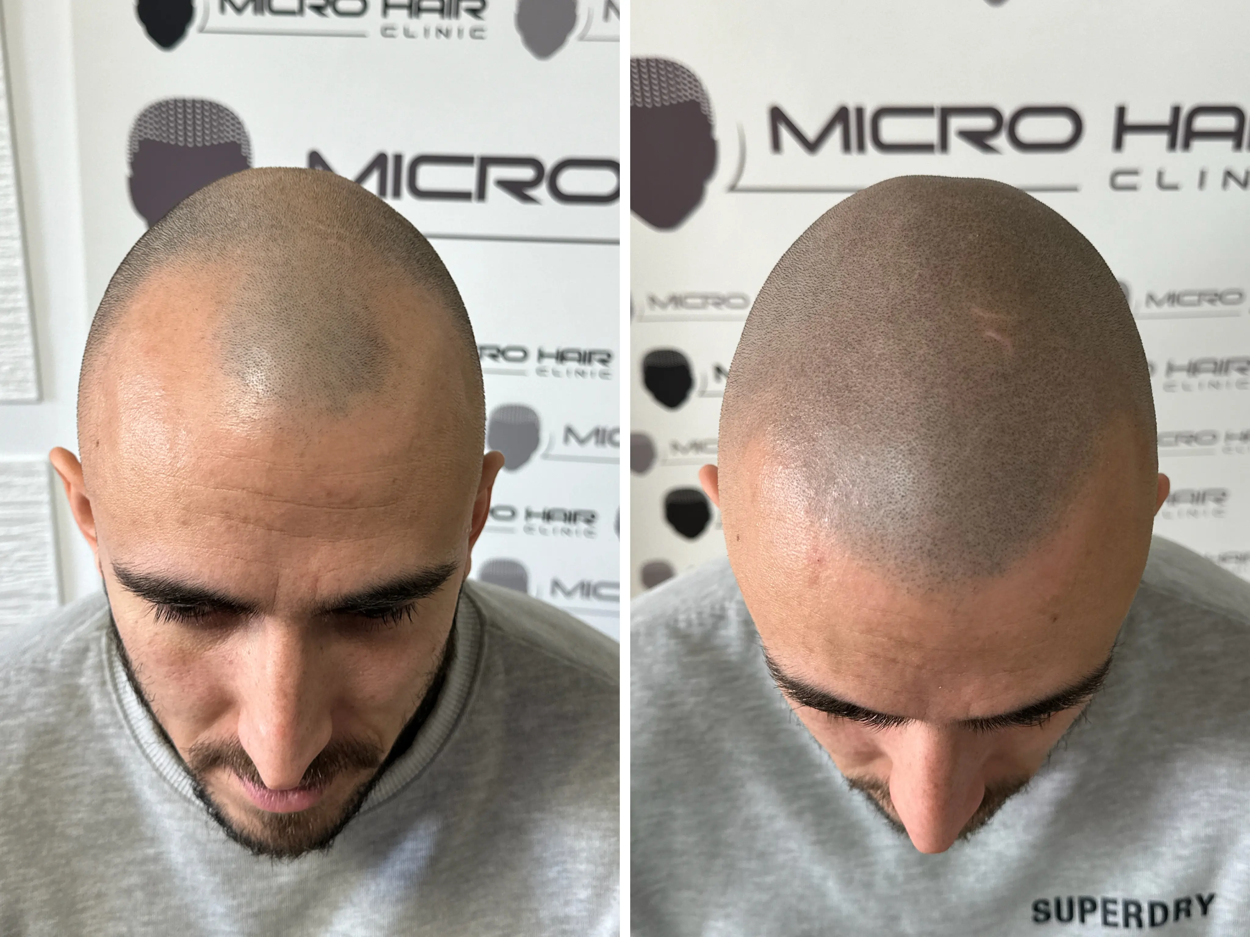 SMP rezultat pred in po - tretman mikropigmentacije 3