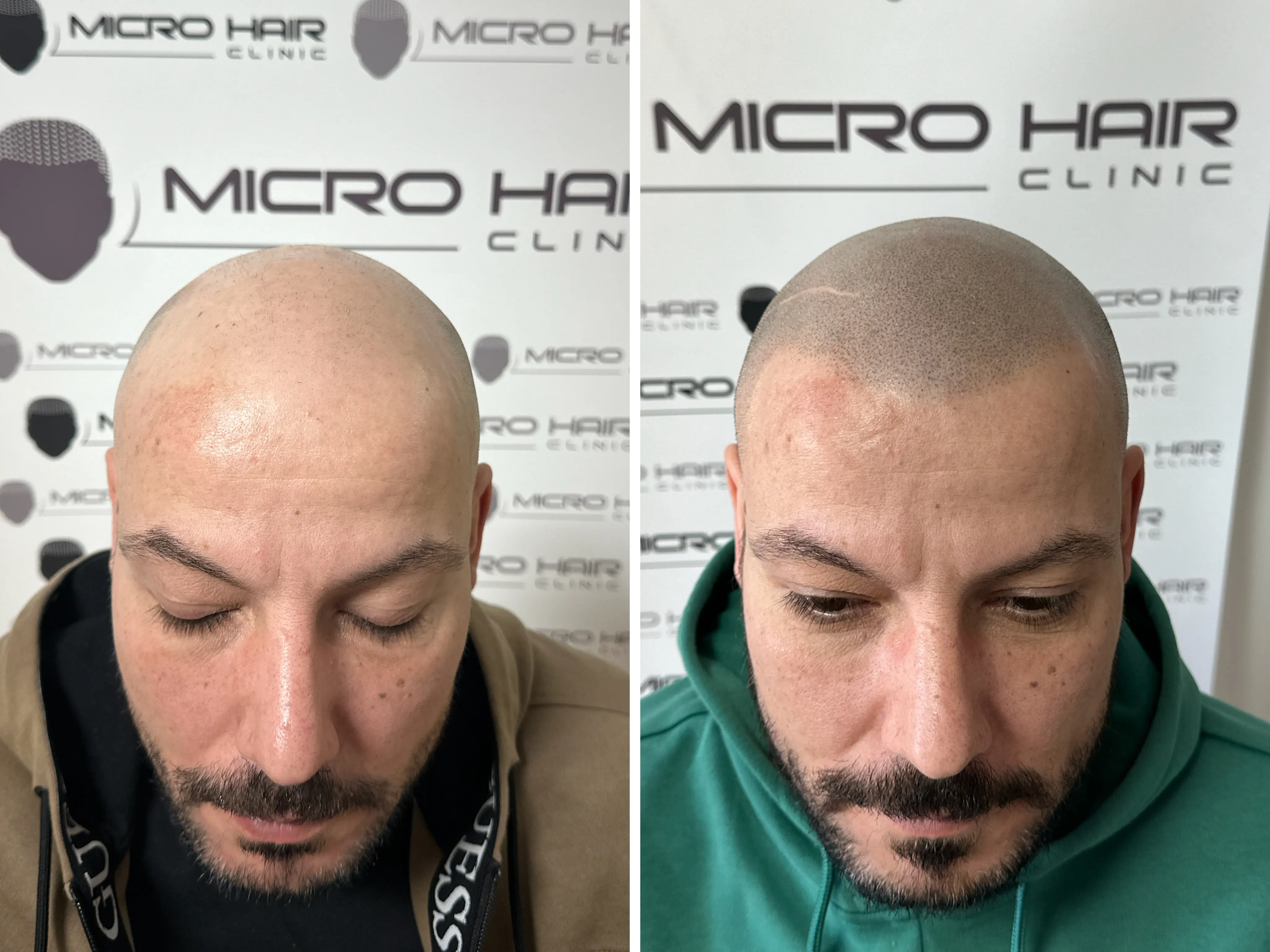 SMP rezultat pred in po - tretman mikropigmentacije 7