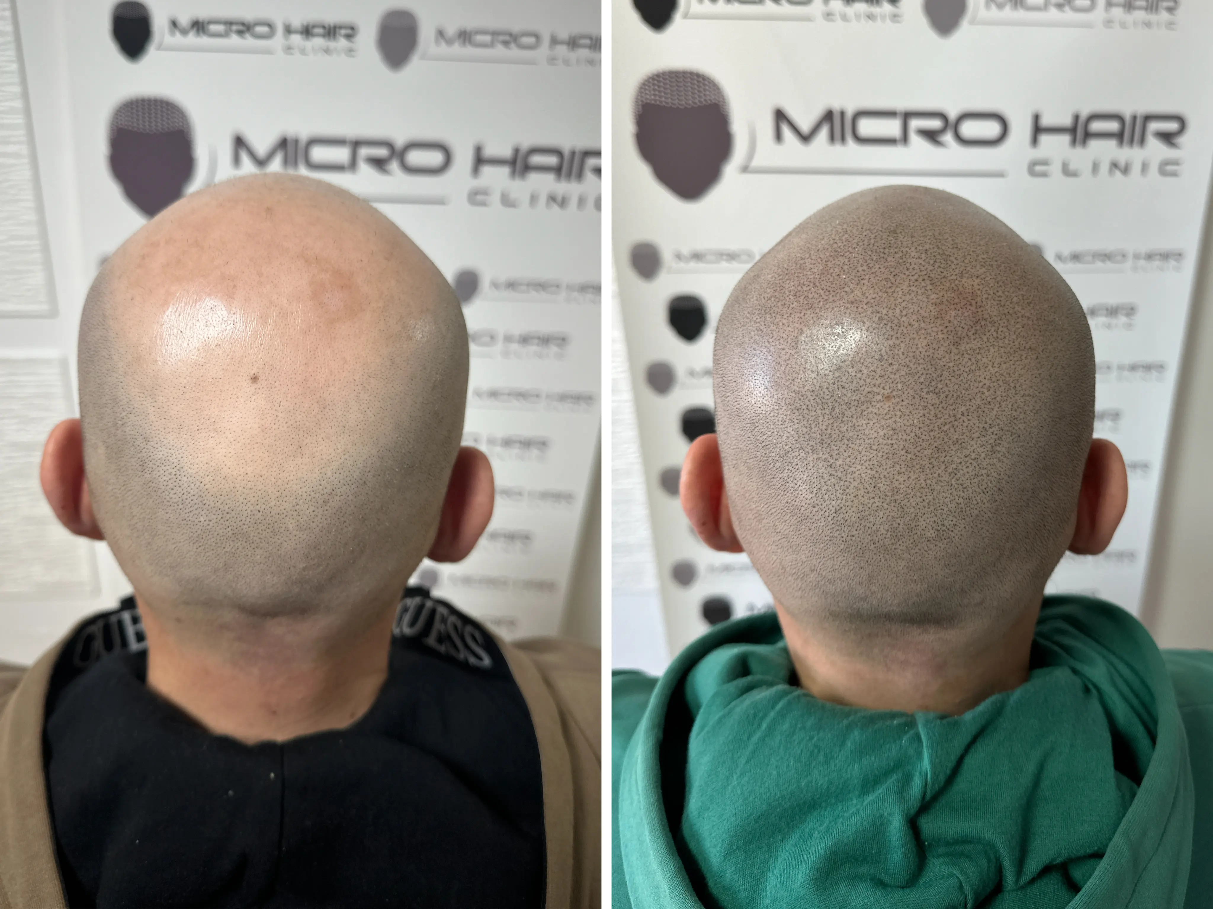 SMP rezultat pred in po - tretman mikropigmentacije 8