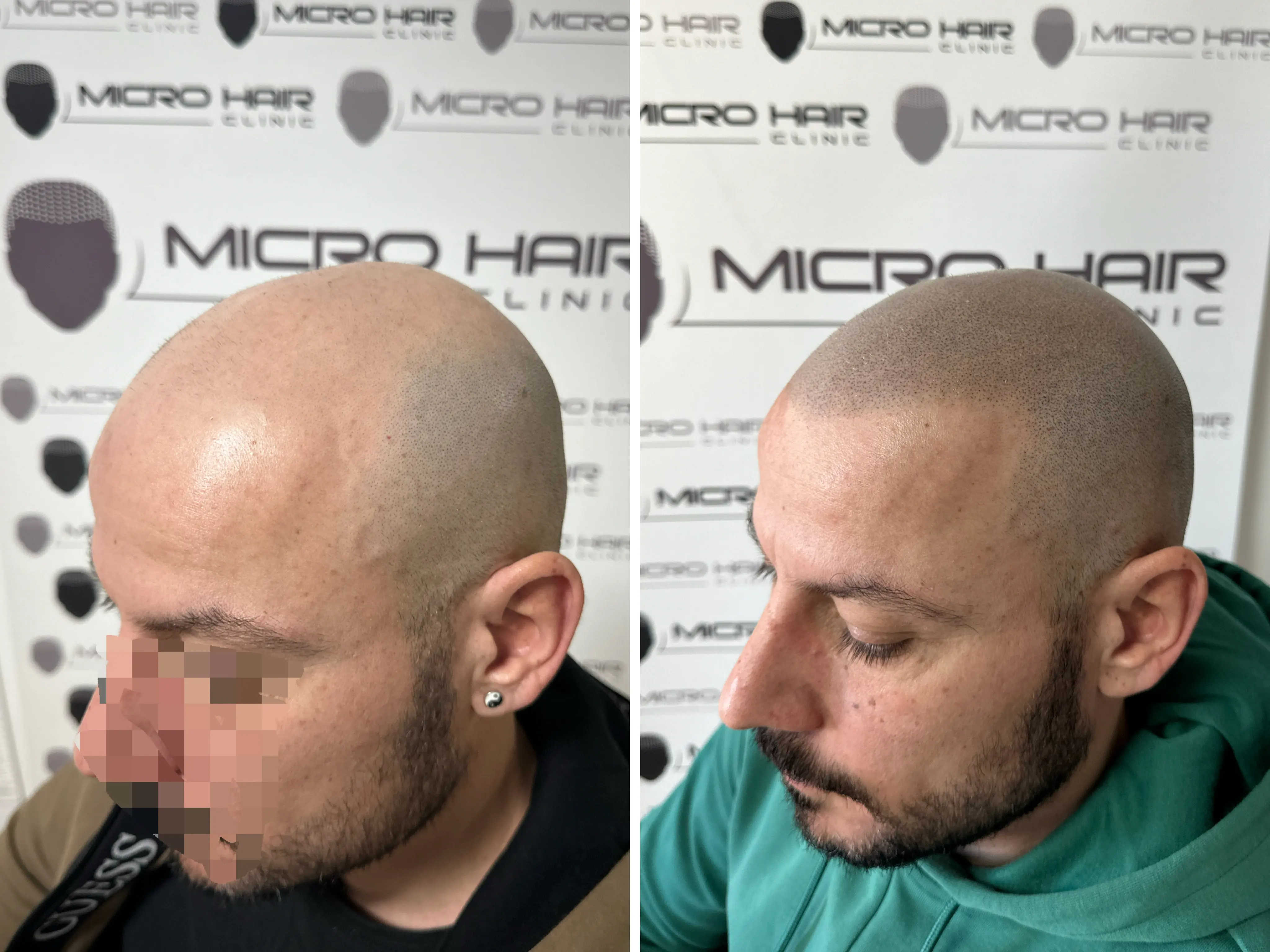 SMP rezultat pred in po - tretman mikropigmentacije 9