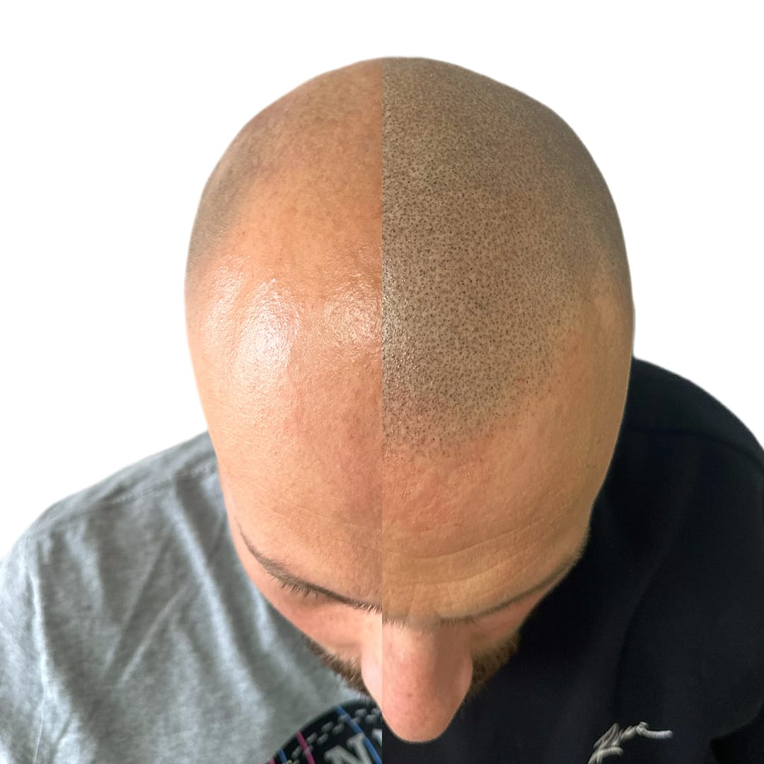 SMP tretman - fotografija iz galerije Micro Hair Clinic