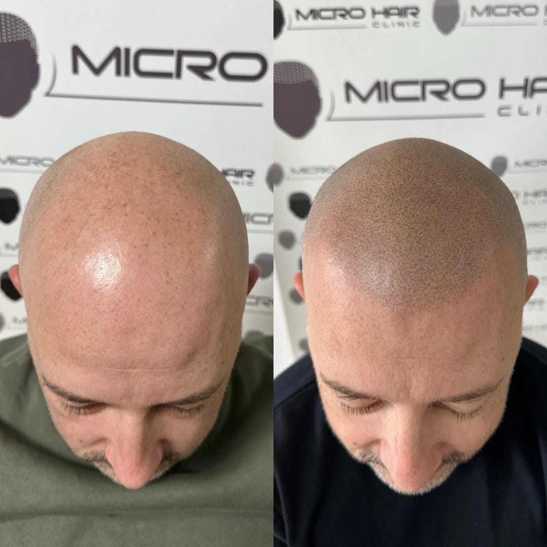 SMP tretman - fotografija iz galerije Micro Hair Clinic