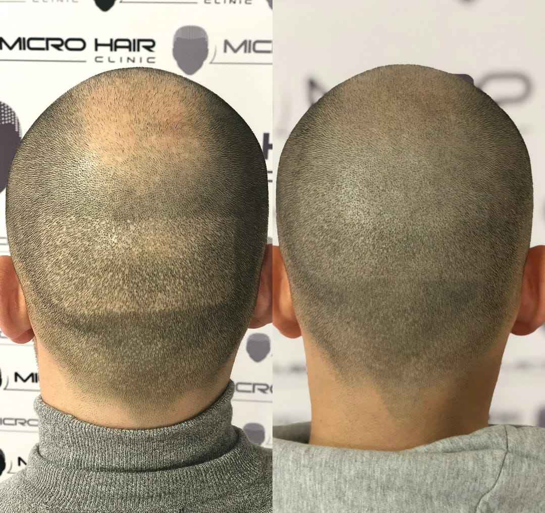 SMP tretman - fotografija iz galerije Micro Hair Clinic