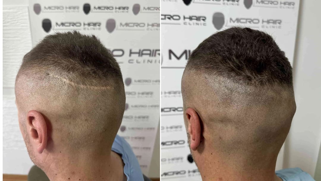 SMP za brazgotine – po presaditvi, poškodbah ali operacijah