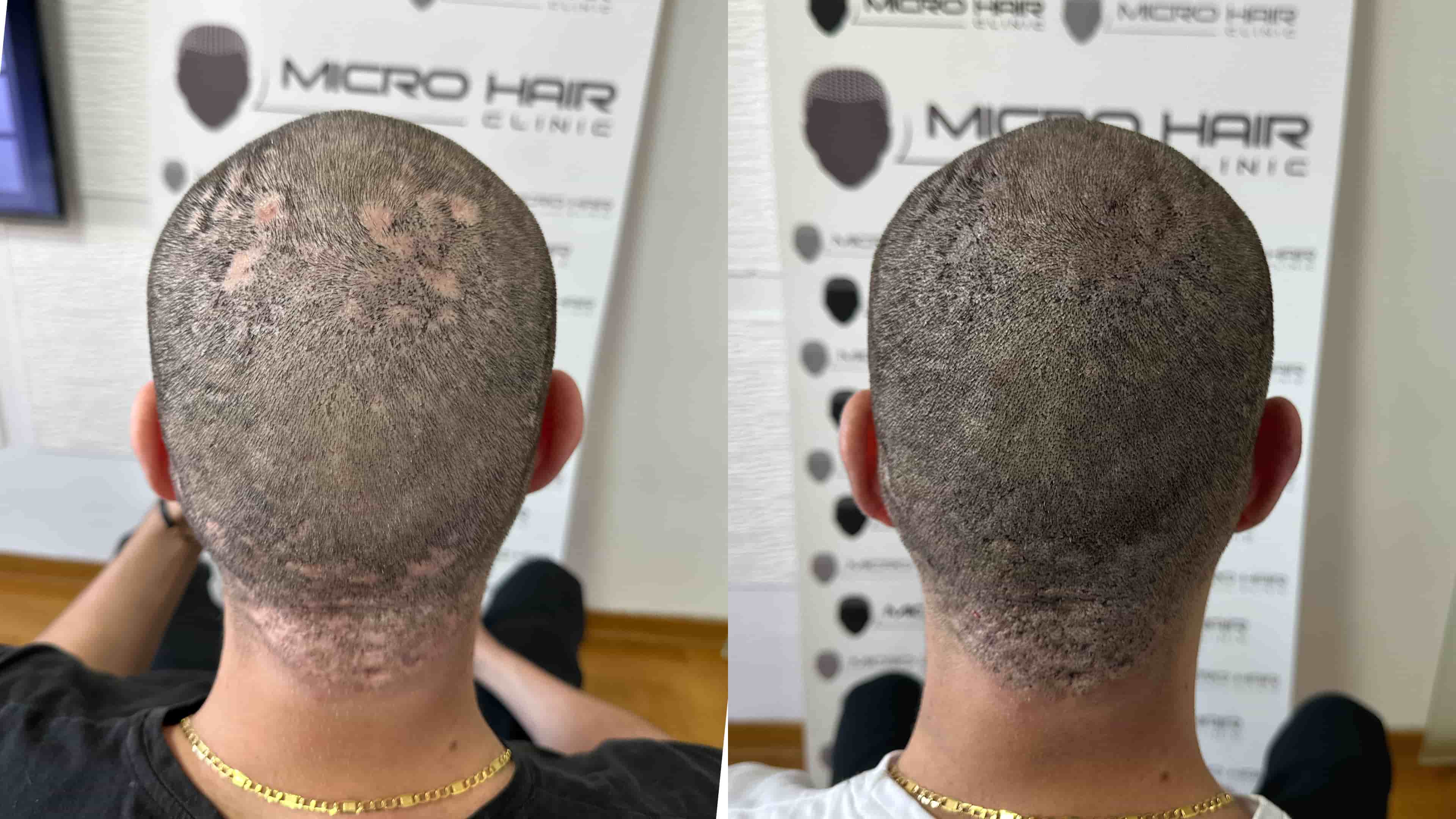 SMP result on a client with alopecia areata