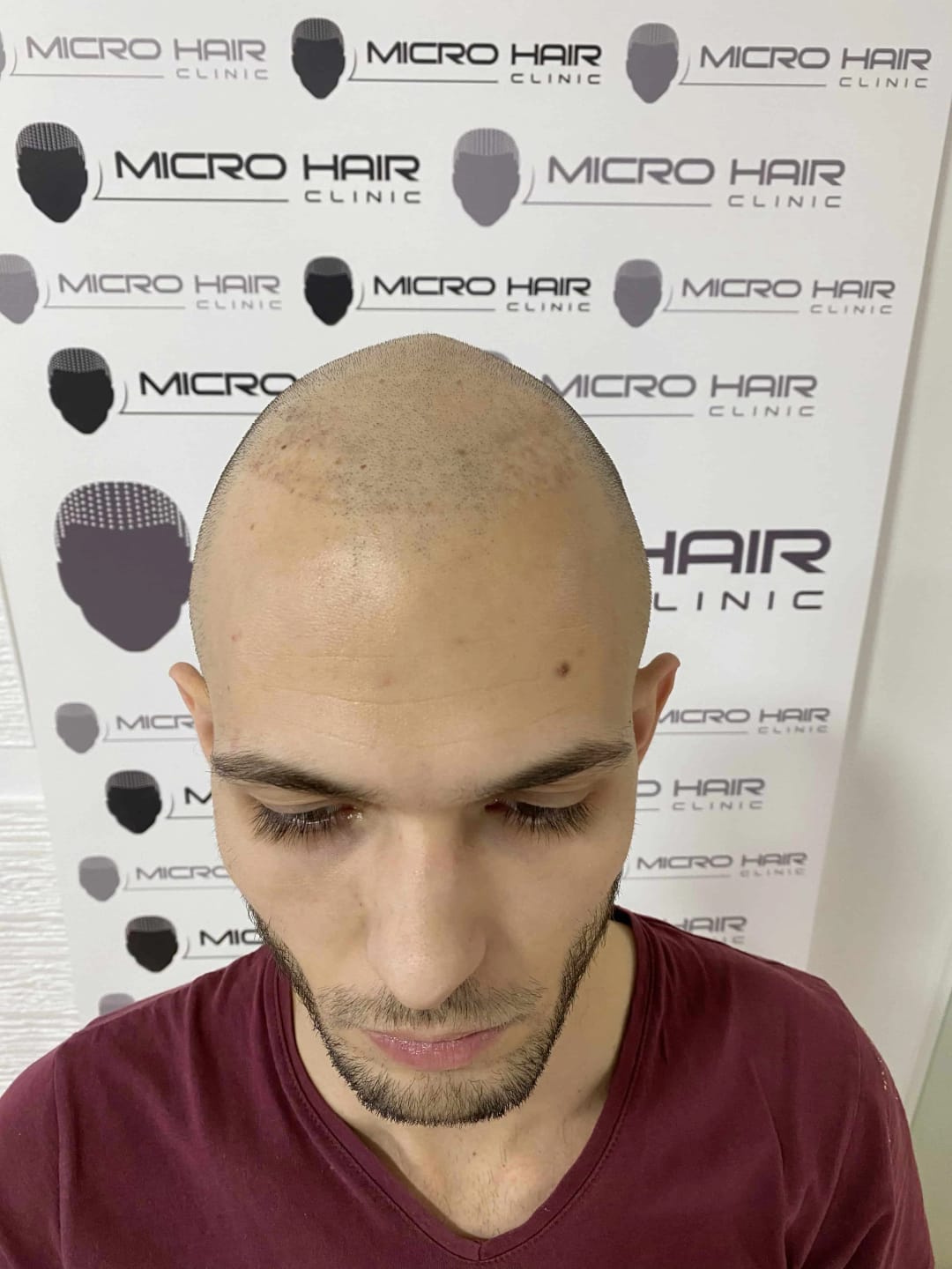 SMP tretman - fotografija iz galerije Micro Hair Clinic