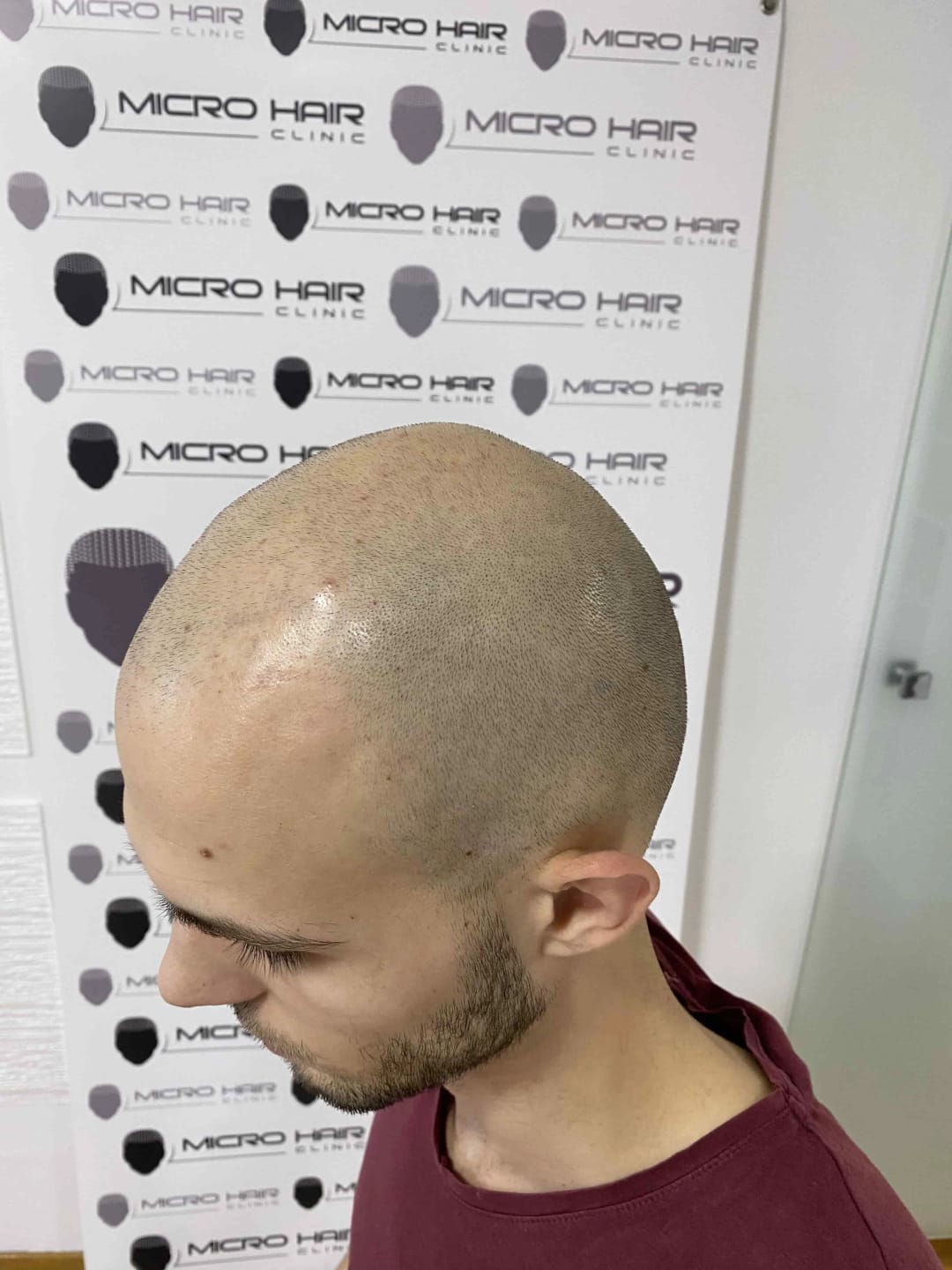 SMP tretman - fotografija iz galerije Micro Hair Clinic