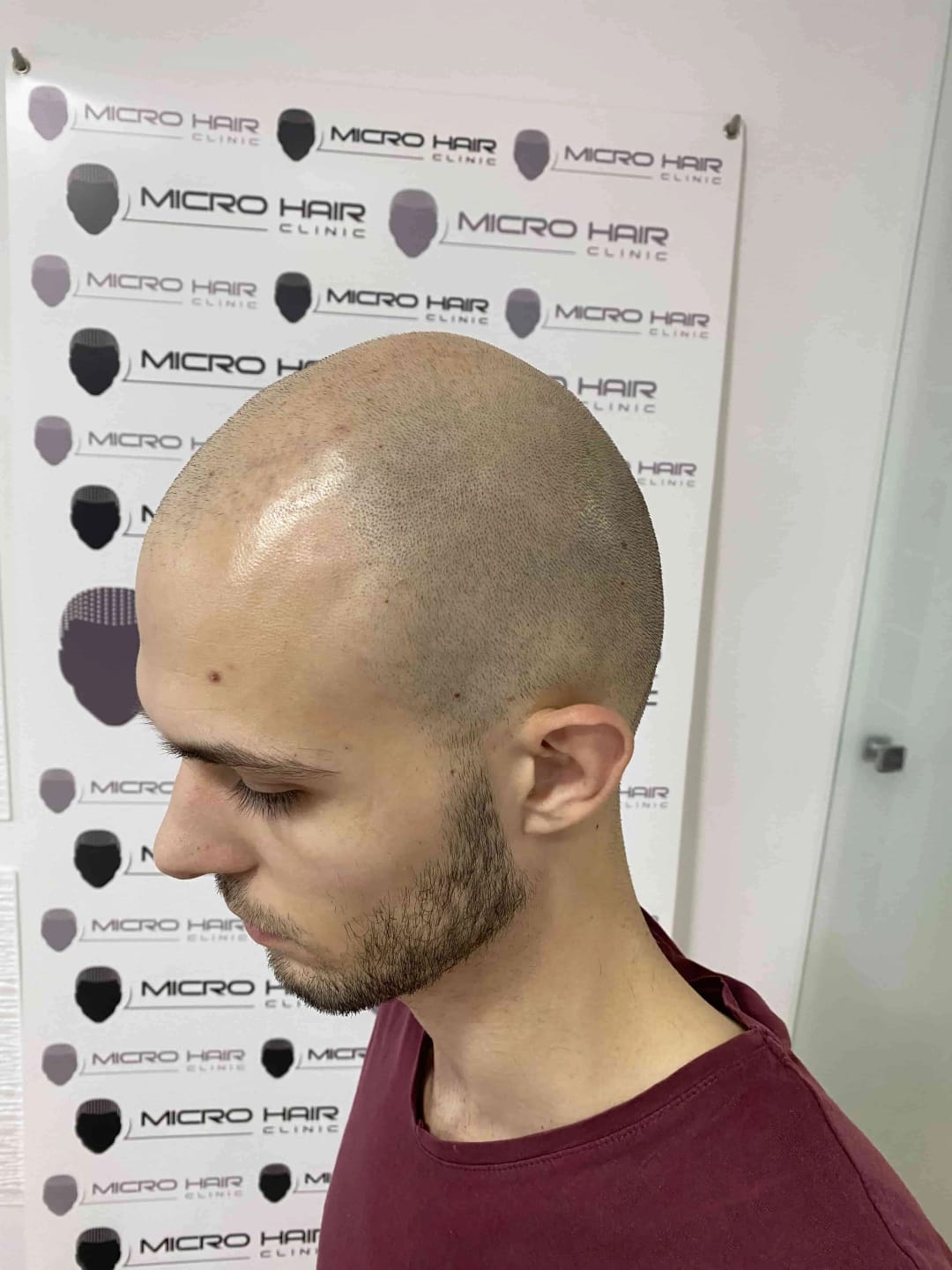 SMP tretman - fotografija iz galerije Micro Hair Clinic