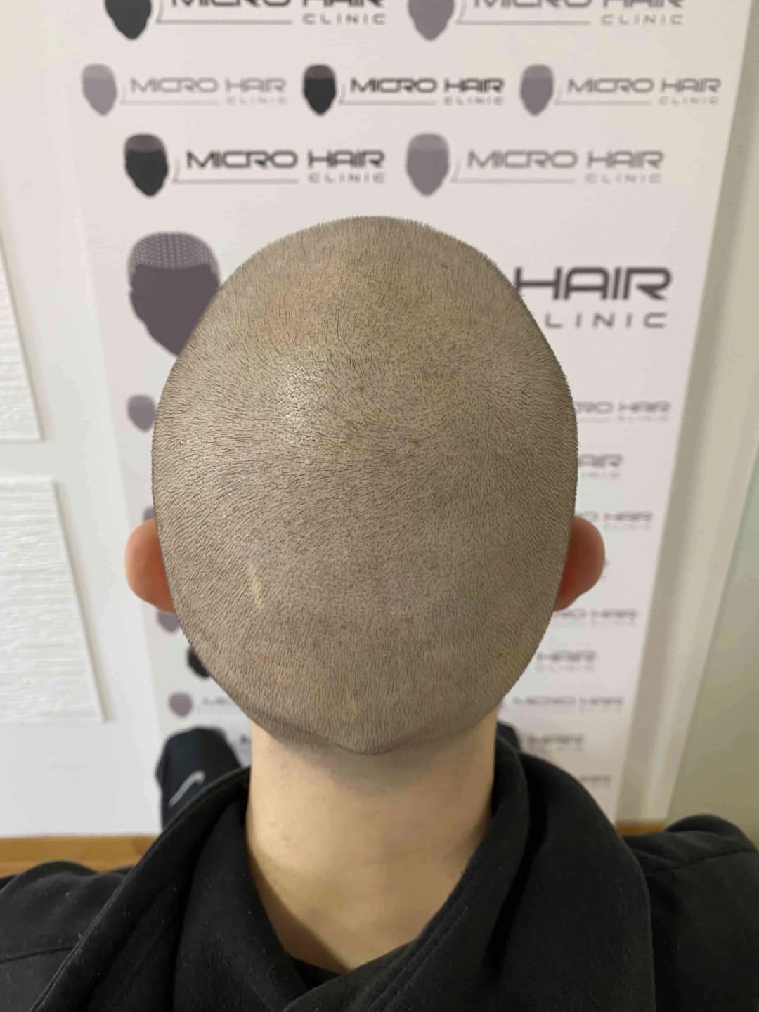 SMP tretman - fotografija iz galerije Micro Hair Clinic