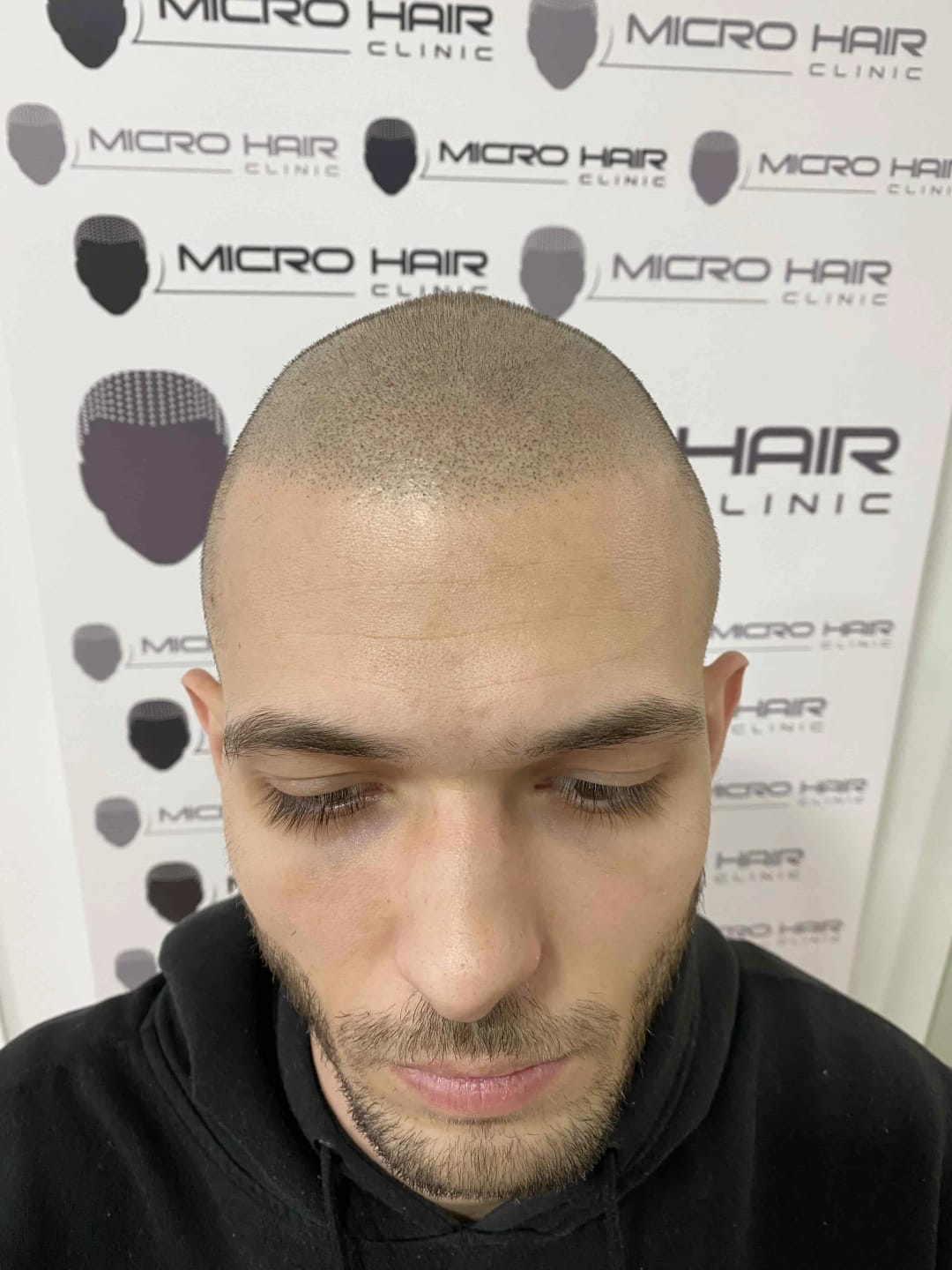 SMP tretman - fotografija iz galerije Micro Hair Clinic