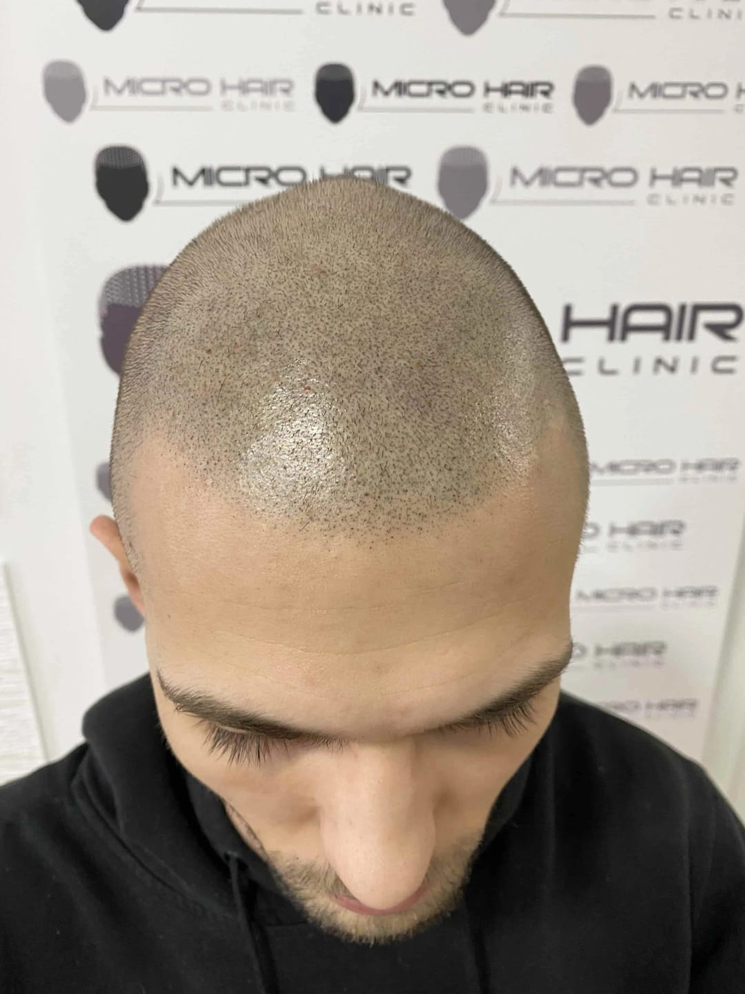 SMP tretman - fotografija iz galerije Micro Hair Clinic