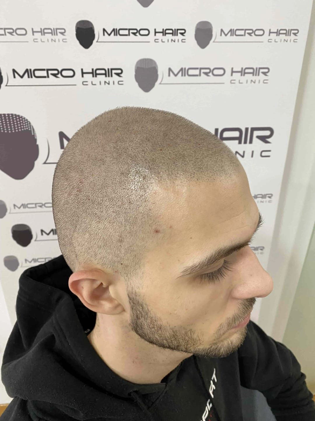 SMP tretman - fotografija iz galerije Micro Hair Clinic