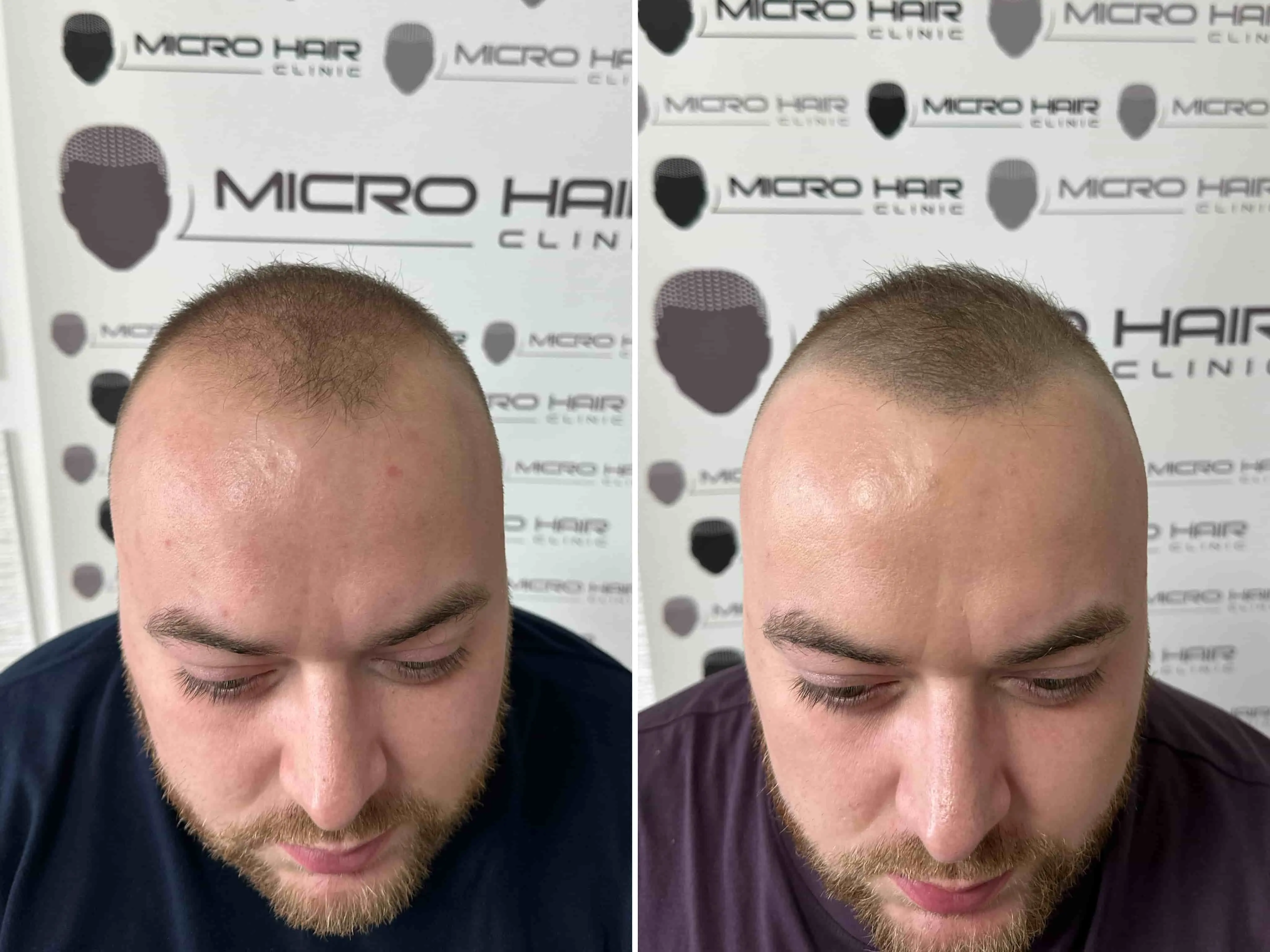 SMP rezultat pred in po - tretman mikropigmentacije 1