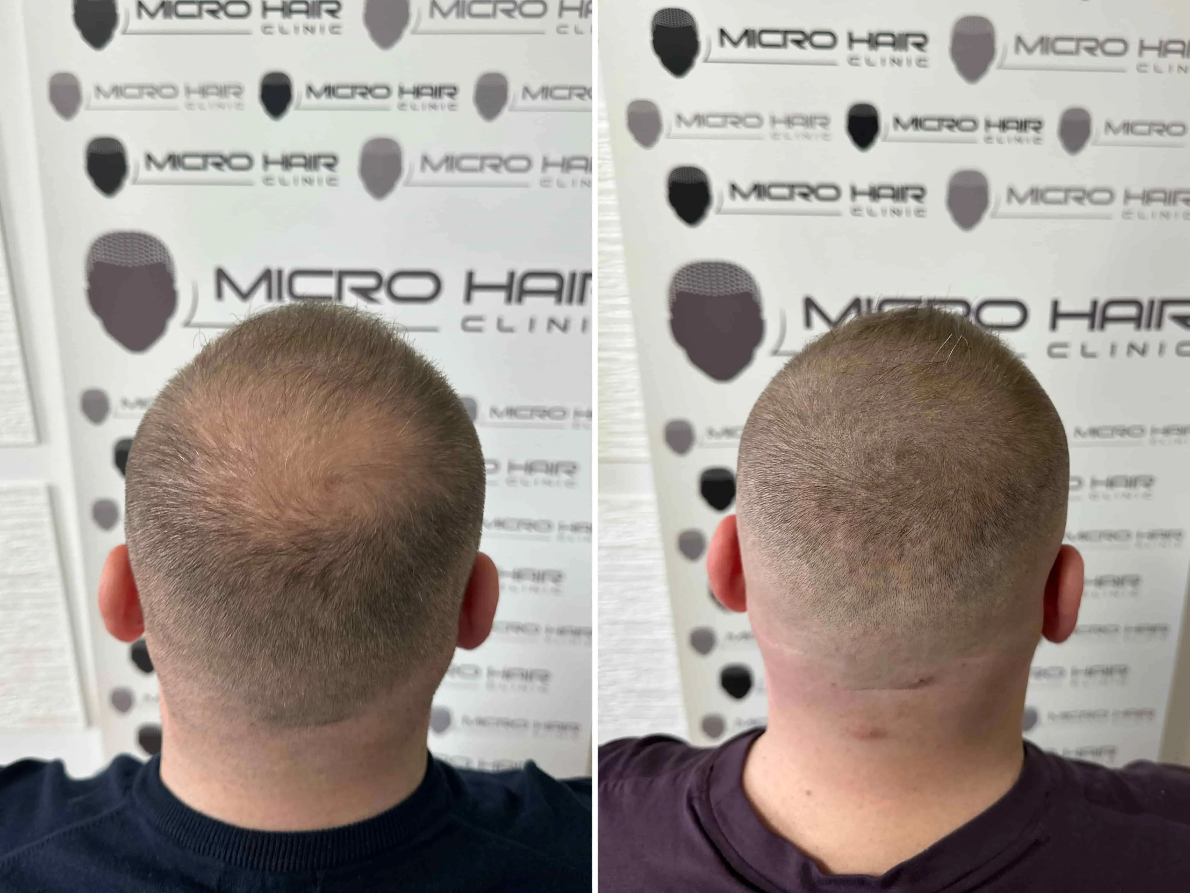 SMP rezultat pred in po - tretman mikropigmentacije 3