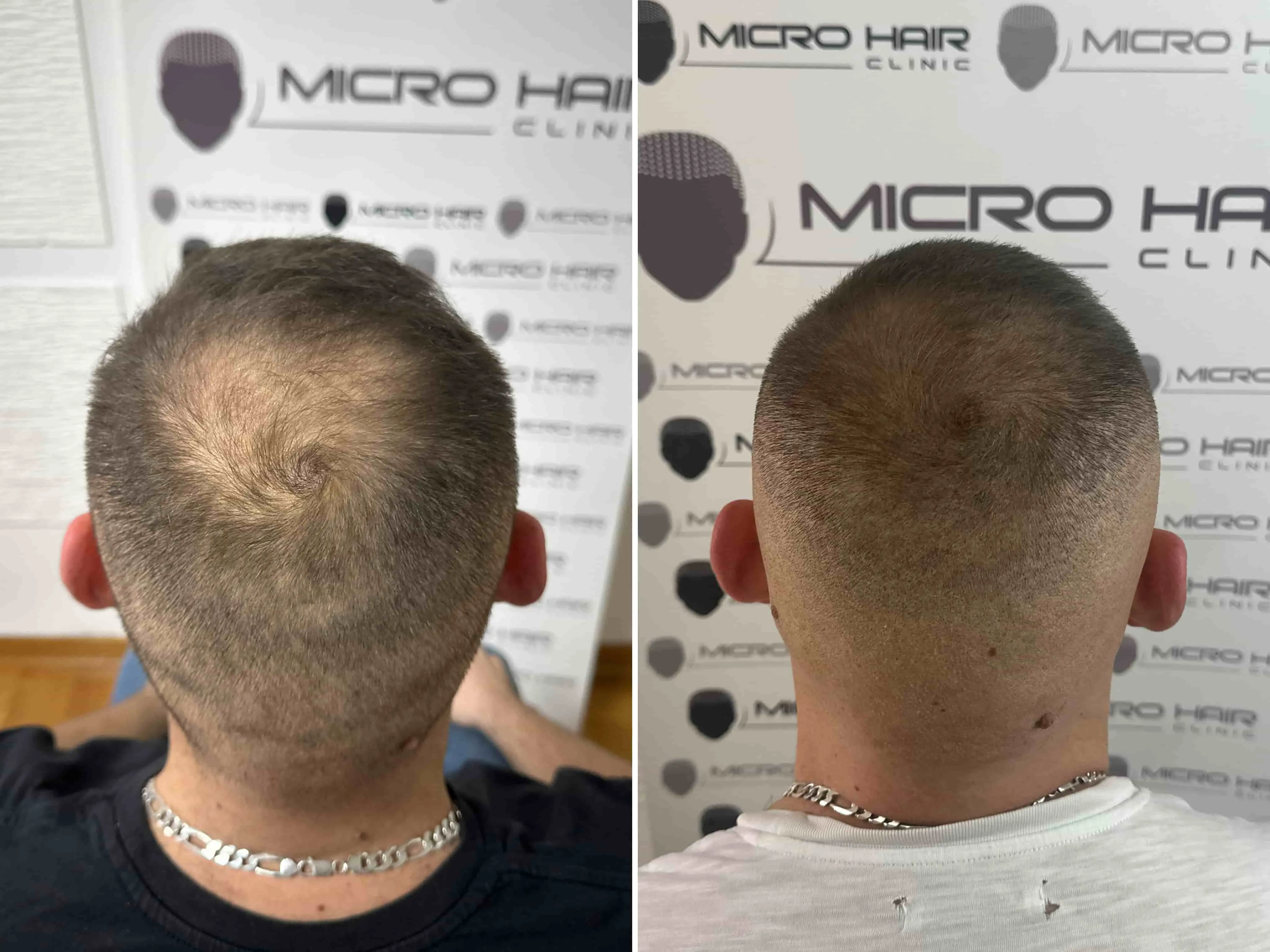 SMP rezultat pred in po - tretman mikropigmentacije 4