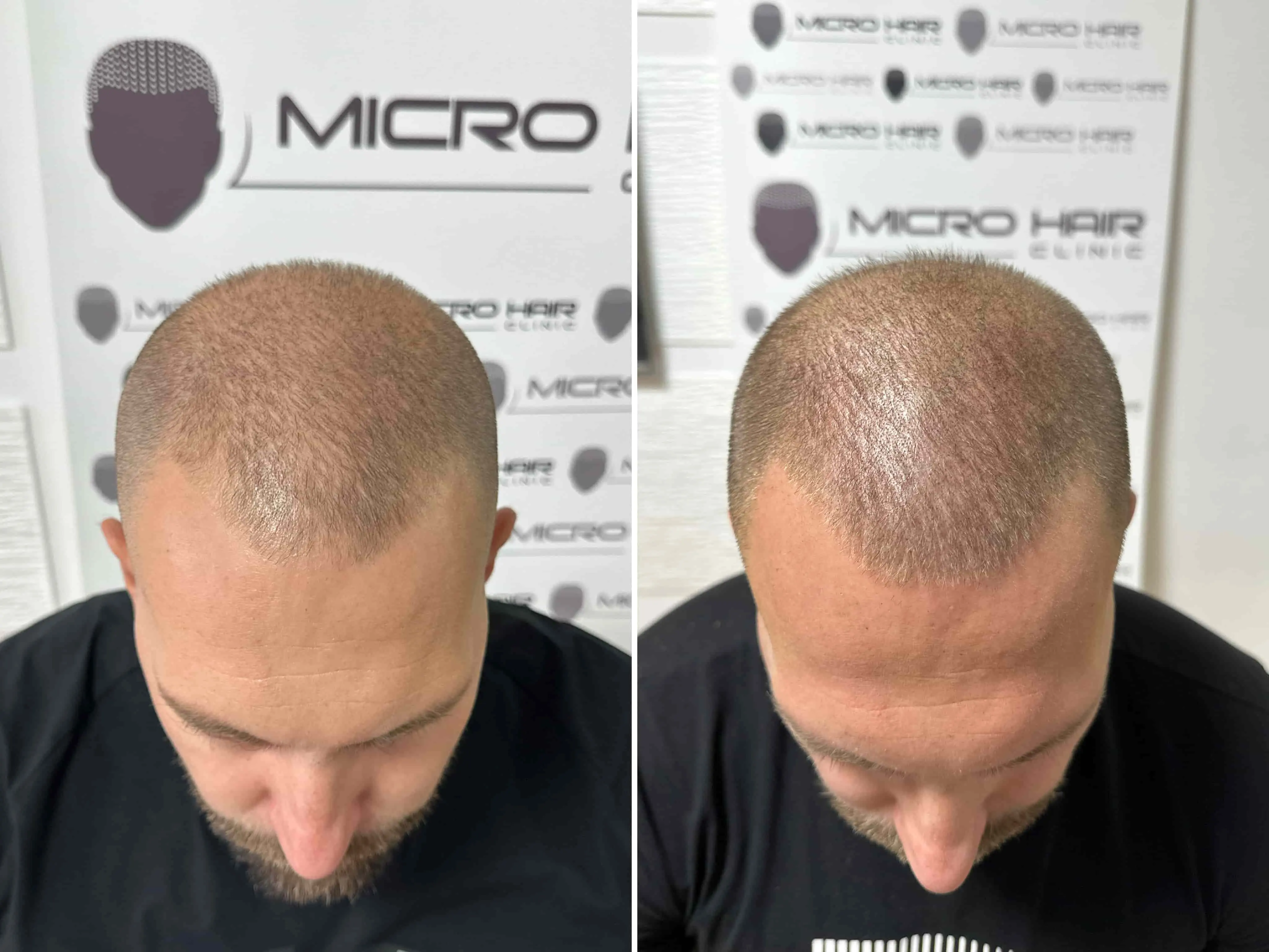 SMP rezultat pred in po - tretman mikropigmentacije 7