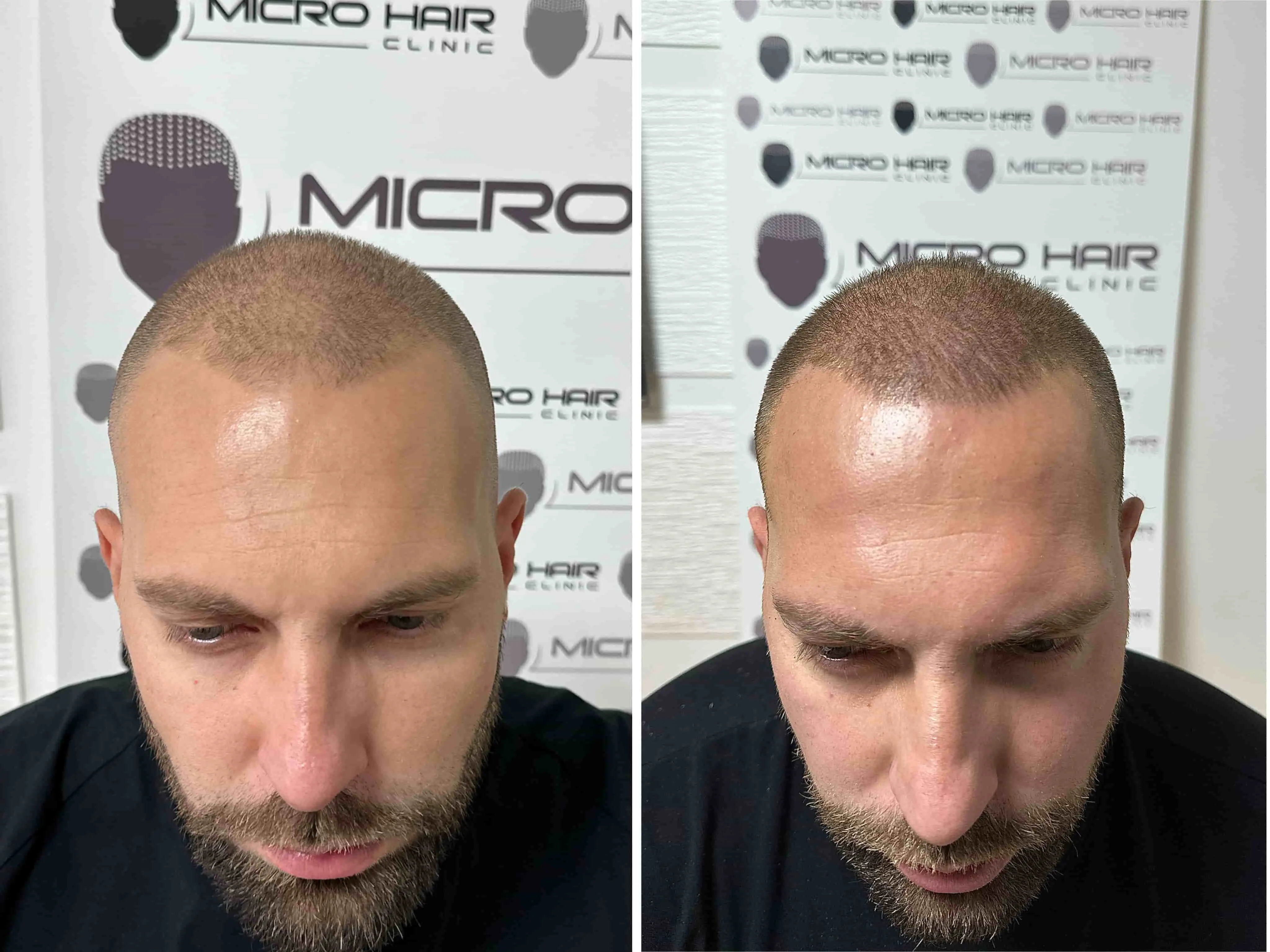 SMP rezultat pred in po - tretman mikropigmentacije 8