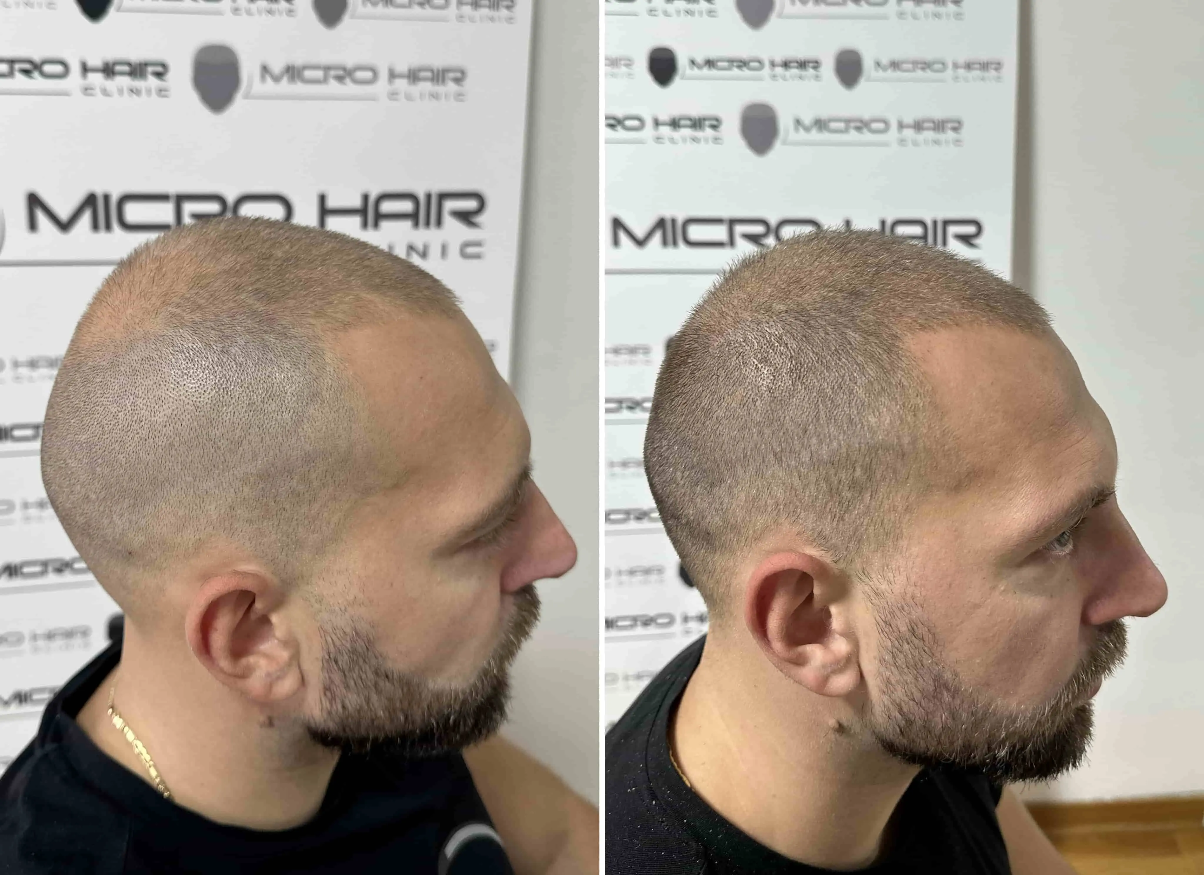 SMP rezultat pred in po - tretman mikropigmentacije 10