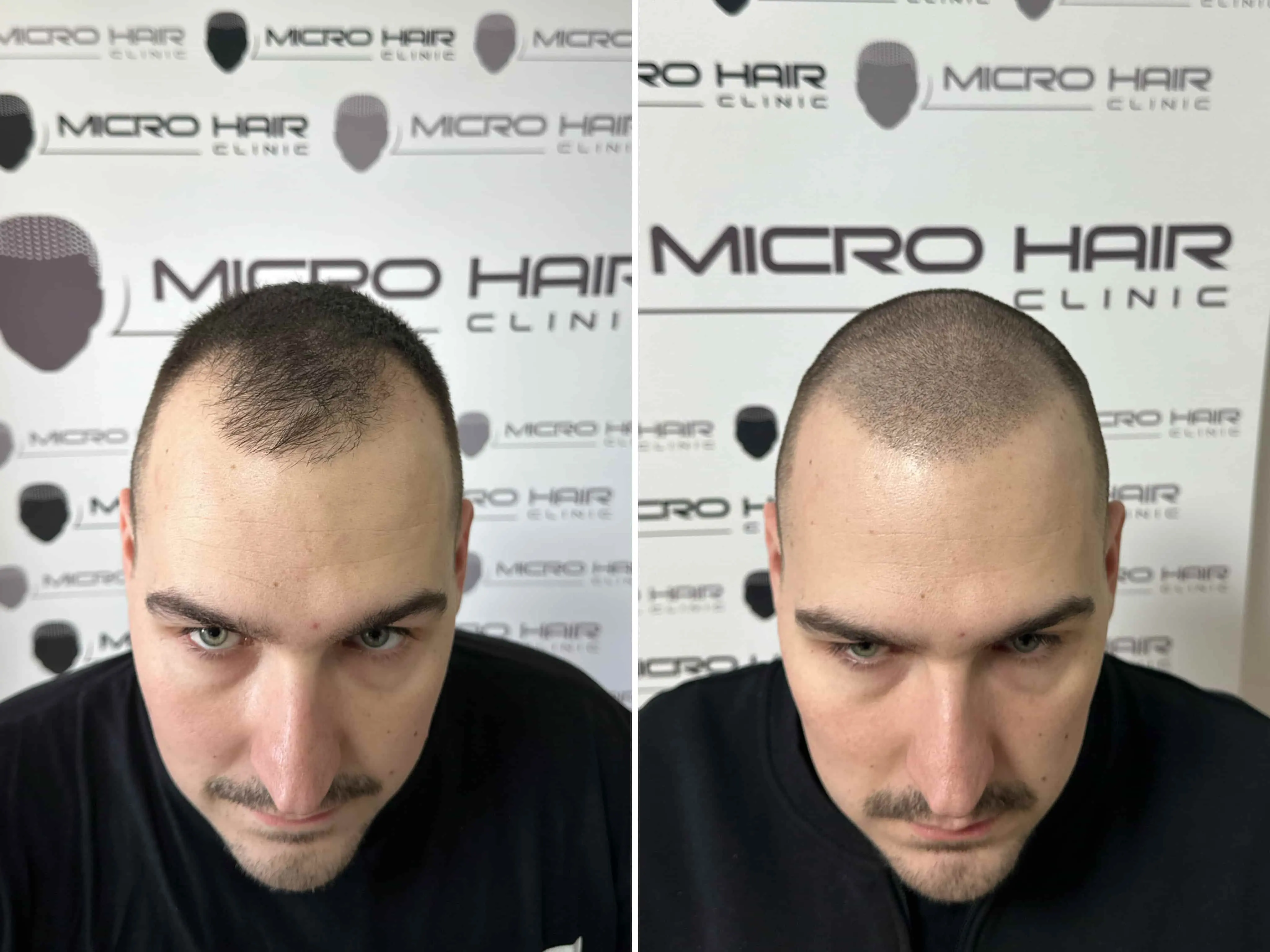 SMP rezultat pred in po - tretman mikropigmentacije 11