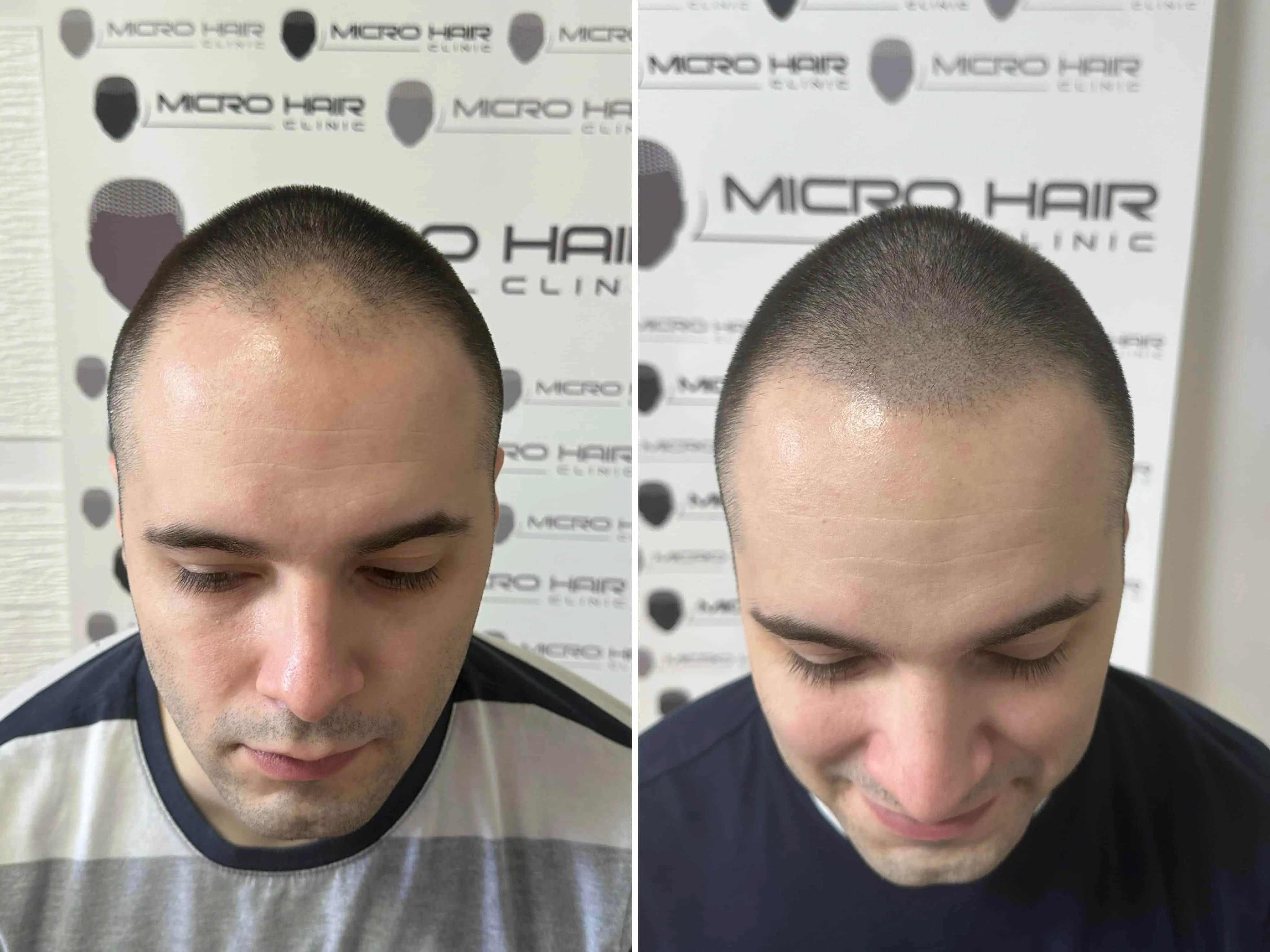 SMP rezultat pred in po - tretman mikropigmentacije 14