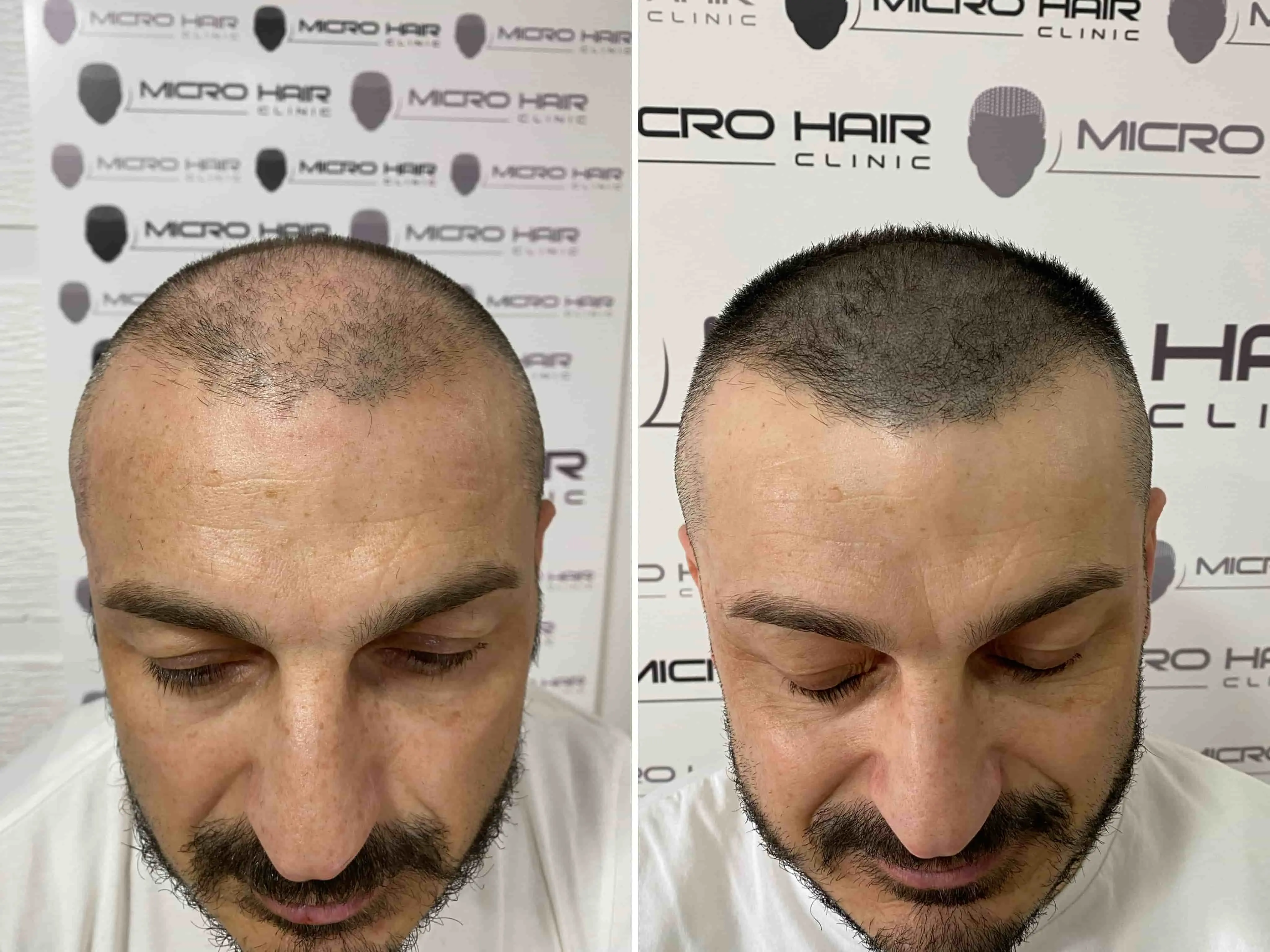 SMP rezultat pred in po - tretman mikropigmentacije 15